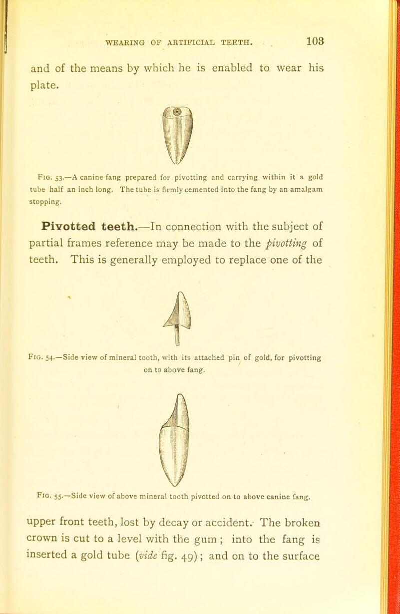 and of the means by which he is enabled to wear his plate. Fig. 53.—A canine fang prepared for pivotting and carrying within it a gold tube half an inch long. The tube is firmly cemented into the fang by an amalgam stopping. PiYotted teeth.—In connection with the subject of partial frames reference may be made to the pivotting of teeth. This is generally employed to replace one of the Fig. 54.—Side view of mineral tooth, with its attached pin of gold, for pivotting on to above fang. Fig. 55.—Side view of above mineral tooth pivotted on to above canine fang. upper front teeth, lost by decay or accident.- The broken crown is cut to a level with the gum ; into the fang is inserted a gold tube {vide fig. 49); and on to the surface