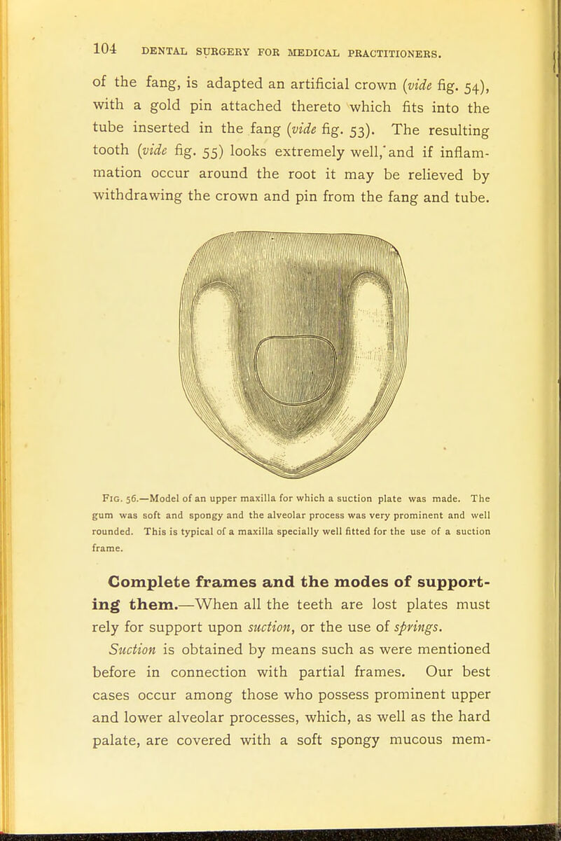 of the fang, is adapted an artificial crown (vide fig. 54), with a gold pin attached thereto which fits into the tube inserted in the fang (vide fig. 53). The resulting tooth (vide fig. 55) looks extremely well,'and if inflam- mation occur around the root it may be relieved by withdrawing the crown and pin from the fang and tube. Fig. 56.—Model of an upper maxilla for which a suction plate was made. The gum was soft and spongy and the alveolar process was very prominent and well rounded. This is typical of a maxilla specially well fitted for the use of a suction frame. Complete frames and the modes of support- ing them.—When all the teeth are lost plates must rely for support upon suction, or the use of springs. Suction is obtained by means such as were mentioned before in connection with partial frames. Our best cases occur among those who possess prominent upper and lower alveolar processes, which, as well as the hard palate, are covered with a soft spongy mucous mem-