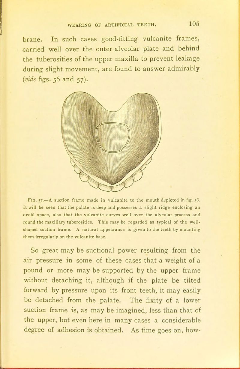 brane. In such cases good-fitting vulcanite frames, carried well over the outer alveolar plate and behind the tuberosities of the upper maxilla to prevent leakage during slight movement, are found to answer admirably (vide figs. 56 and 57). Fig. 57.—A suction frame made in vulcanite to the mouth depicted in fig. 5G. It will be seen that the palate is deep and possesses a slight ridge enclosing an ovoid space, also that the vulcanite curves well over the alveolar process and round the maxillary tuberosities. This may be regarded as typical of the well- shaped suction frame. A natural appearance is given to the teeth by mounting them irregularly on the vulcanite base. So great may be suctional power resulting from the air pressure in some of these cases that a weight of a pound or more may be supported by the upper frame without detaching it, although if the plate be tilted forward by pressure upon its front teeth, it may easily be detached from the palate. The fixity of a lower suction frame is, as may be imagined, less than that of the upper, but even here in many cases a considerable degree of adhesion is obtained. As time goes on, how-