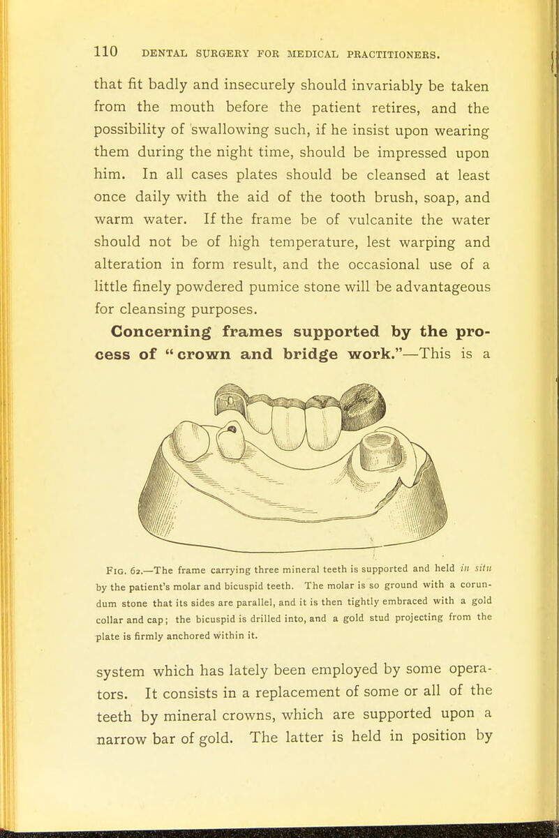 that fit badly and insecurely should invariably be taken from the mouth before the patient retires, and the possibility of swallowing such, if he insist upon wearing them during the night time, should be impressed upon him. In all cases plates should be cleansed at least once daily with the aid of the tooth brush, soap, and warm water. If the frame be of vulcanite the water should not be of high temperature, lest warping and alteration in form result, and the occasional use of a little finely powdered pumice stone will be advantageous for cleansing purposes. Concerning frames supported by the pro- cess of  crown and bridge work.—This is a Fig. 62.—The frame carrying three mineral teeth is supported and held in situ by the patient's molar and bicuspid teeth. The molar is so ground with a corun- dum stone that its sides are parallel, and it is then tightly embraced with a gold collar and cap; the bicuspid is drilled into, and a gold stud projecting from the plate is firmly anchored within it. system which has lately been employed by some opera- tors. It consists in a replacement of some or all of the teeth by mineral crowns, which are supported upon a narrow bar of gold. The latter is held in position by