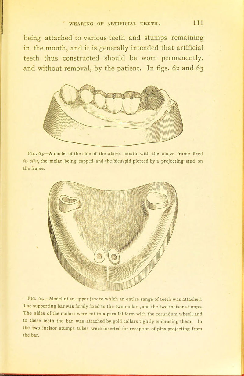 being attached to various teeth and stumps remaining in the mouth, and it is generally intended that artificial teeth thus constructed should be worn permanently, and without removal, by the patient. In figs. 62 and 63 Fig. 63.—A model of the side of the above mouth with the above frame fixed in situ, the molar being capped and the bicuspid pierced by a projecting stud on the frame. Fig. 64.—Model of an upper jaw to which an entire range of teeth was attached. The supporting bar was firmly fixed to the two molars, and the two incisor stumps. The sides of the molars were cut to a parallel form with the corundum wheel, and to these teeth the bar was attached by gold collars tightly embracing them. In the two incisor stumps tubes were inserted for reception of pins projecting from the bar.
