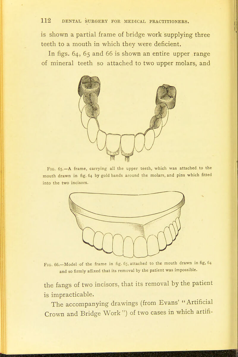 is shown a partial frame of bridge work supplying three teeth to a mouth in which they were deficient. In figs. 64, 65 and 66 is shown an entire upper range of mineral teeth so attached to two upper molars, and Fig. 65.—A frame, carrying all the upper teeth, which was attached to the mouth drawn in fig. 64 by gold bands around the molars, and pins which fitted into the two incisors. Fig. 66 — Model of the frame in fig. 65, attached to the mouth drawn in fig, 64 and so firmly affixed that its removal by the patient was impossible. the fangs of two incisors, that its removal by the patient is impracticable. The accompanying drawings (from Evans' Artificial Crown and Bridge Work ) of two cases in which artifi-