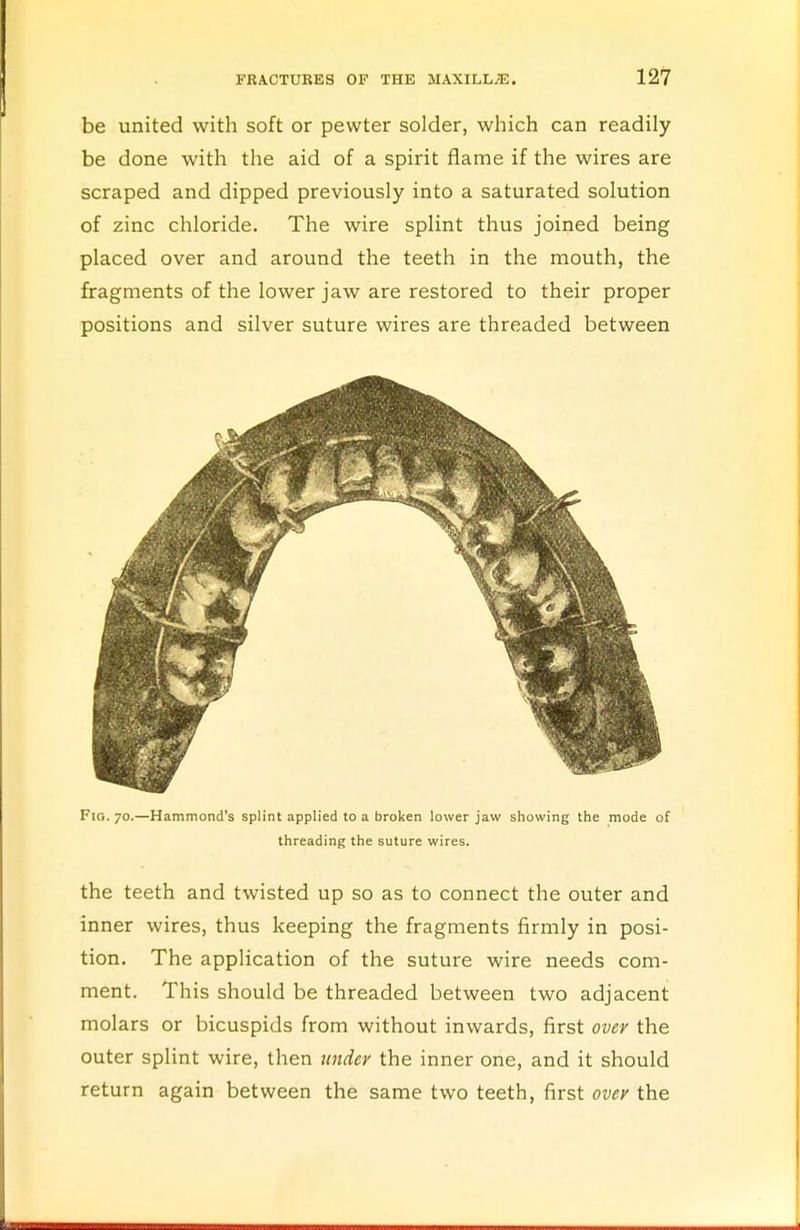 be united with soft or pewter solder, which can readily be done with the aid of a spirit flame if the wires are scraped and dipped previously into a saturated solution of zinc chloride. The wire splint thus joined being placed over and around the teeth in the mouth, the fragments of the lower jaw are restored to their proper positions and silver suture wires are threaded between Fig. 70.—Hammond's splint applied to a broken lower jaw showing the mode of threading the suture wires. the teeth and twisted up so as to connect the outer and inner wires, thus keeping the fragments firmly in posi- tion. The application of the suture wire needs com- ment. This should be threaded between two adjacent molars or bicuspids from without inwards, first over the outer splint wire, then under the inner one, and it should return again between the same two teeth, first over the