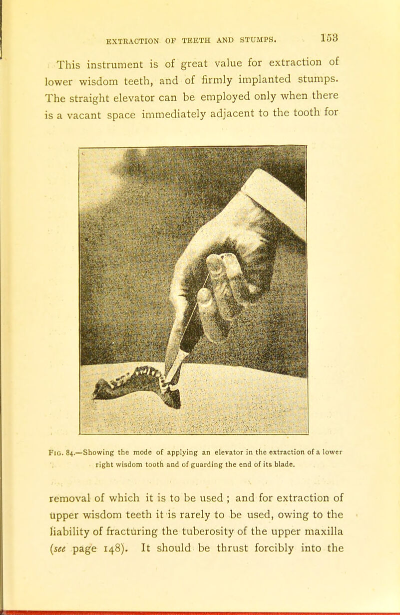 This instrument is of great value for extraction of lower wisdom teeth, and of firmly implanted stumps. The straight elevator can be employed only when there is a vacant space immediately adjacent to the tooth for Fig. 84.—Showing the mode of applying an elevator in the extraction of a lower right wisdom tooth and of guarding the end of its blade. removal of which it is to be used ; and for extraction of upper wisdom teeth it is rarely to be used, owing to the liability of fracturing the tuberosity of the upper maxilla (see page 148). It should be thrust forcibly into the