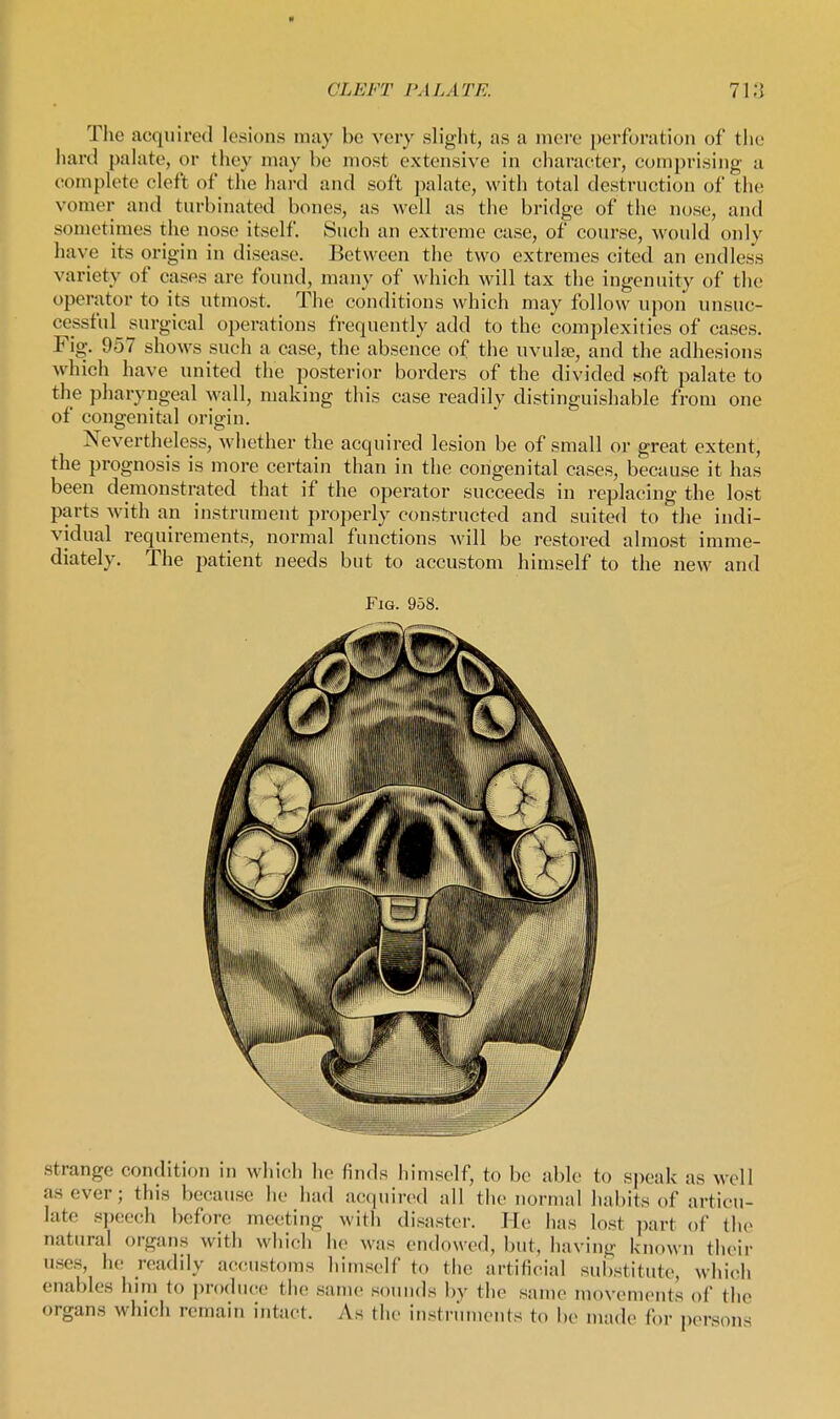Tlie acquired lesions may be very slight, as a mere perforation of the hard palate, or tliey may he most extensive in character, comprising a complete cleft of tlie hard and soft palate, with total destruction of the vomer and turbinated bones, as well as the bridge of the nose, and sometimes the nose itself. Such an exti-eme case, of course, would only have its origin in disease. Between the two extremes cited an endless variety of cases are found, many of which will tax the ingenuity of the operator to its utmost. The conditions which may follow upon unsuc- cessful surgical operations frequently add to the complexities of cases. Fig. 957 shows such a case, the absence of the uvuIje, and the adhesions which have united the posterior borders of the divided soft palate to the pharyngeal wall, making this case readily distinguishable from one of congenital origin. Nevertheless, whether the acquired lesion be of small or great extent, the prognosis is more certain than in the congenital cases, because it has been demonstrated that if the operator succeeds in replacing the lost parts with an instrument properly constructed and suited to the indi- vidual requirements, normal functions will be restored almost imme- diately. The patient needs but to accustom himself to the new and Fig. 958. strange condition in which he finds himself, to be able to speak as well as ever; this because he had acquired all the normal habits of articu- late si)eech l)efore meeting with disaster. He has lost part of the natural organs with which he was endowed, but, having known their uses, he readily accustoms himself to the artificial substitute, which enables him to |)r()duce the same sounds by the same movements of the organs which remain intiict. As the instruments to be made for persons