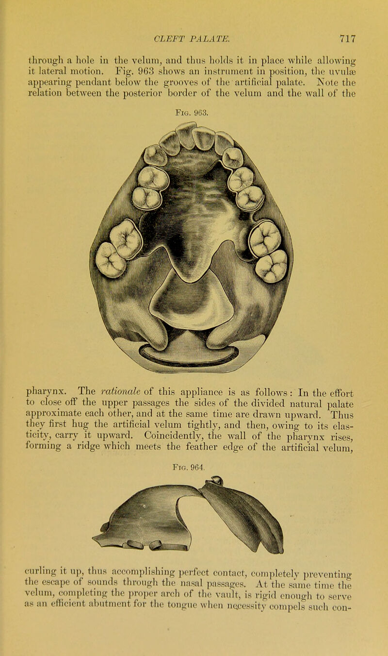 tlirough a hole in the velum, and thus holds it in place while allowing it lateral motion. Fig. 963 shows an instrument in position, the uvula; appearing pendant below the grooves of the artificial palate. Note the relation between the posterior border of the velum and the wall of the Fig. 963. pharynx. The rationale of this appliance is as follows: In the effort to close off the upper passages the sides of the divided natural palate approximate each other, and at the same time are drawn upward. Thus they first hug the artificial velum tightly, and then, owing to its elas- ticity, carry it upward. Coincidently, the wall of the pharynx rises, forming a ridge which meets the feather edge of the artificial velum, Fig. 964. curling it up, thus accomplishing perfect contact, completely preventing the escape of sounds through the nasal passages. At the same time the velum, completing the proper arch of the vault, is rigid enough to serve as an efficient abutment for the tongue when necessity compels such con-