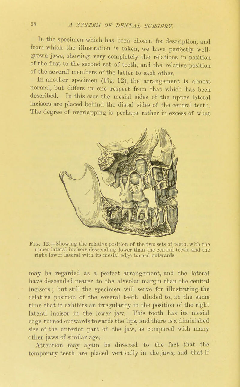 In the specimen which has been chosen for description, and from which the illustration is taken, we have perfectly well- grown jaws, showing very completely the relations in position of the first to the second set of teeth, and the relative position of the several members of the latter to each other. In another specimen (Fig. 12), the arrangement is almost normal, but differs in one respect from that which has been described. In this case the mesial sides of the upper lateral incisors are placed behind the distal sides of the central teeth. The degree of overlapping is perhaps rather in excess of what FiGi 12.—Showing the relative position of the two sets of teeth, with the upper lateral incisors descending lower than the central teeth, and the right lower lateral with its mesial edge turned outwards. may be regarded as a perfect arrangement, and the lateral have descended nearer to the alveolar margin than the central incisors ; but still the specimen will serve for illustrating the relative position of the several teeth alluded to, at the same time that it exhibits an irregularity in the position of the right lateral incisor in the lower jaw. This tooth has its mesial edge turned outwards towards the lips, and there is a diminished size of the anterior part of the jaw, as compai-ed with many other jaws of similar age. Attention may again be directed to the fact that the temporary teeth are placed vertically in the jaws, and that if