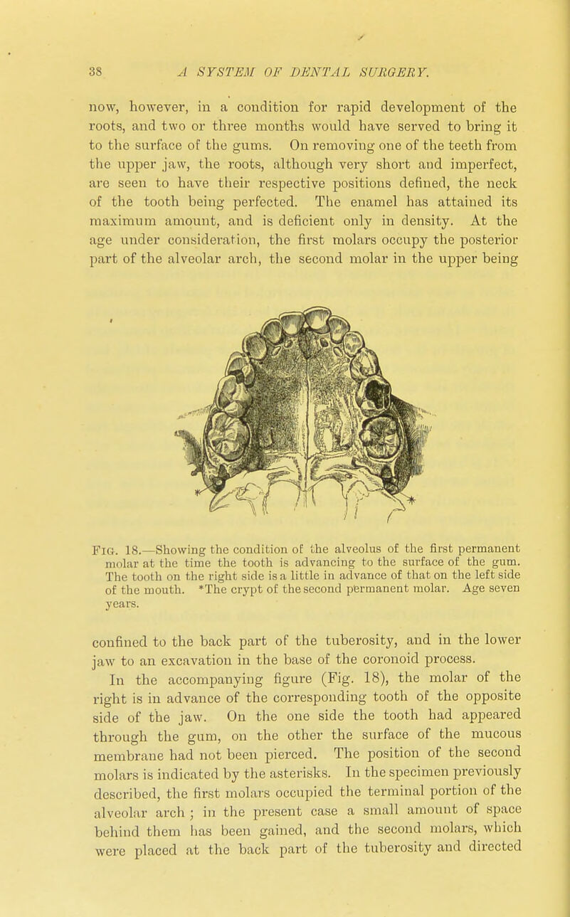 now, however, in a condition for rapid development of the roots, and two or three months would have served to bring it to the surface of the gums. On removing one of the teeth from the upper jaw, the roots, although very short and imperfect, are seen to have their respective positions denned, the neck of the tooth being perfected. The enamel has attained its maximum amount, and is deficient only in density. At the age under consideration, the first molars occupy the posterior part of the alveolar arch, the second molar in the upper being FlG. 18.—Showing the condition of the alveolus of the first permanent molar at the time the tooth is advancing to the surface of the gum. The tooth on the right side is a little in advance of that on the left side of the mouth. The crypt of the second permanent molar. Age seven years. confined to the back part of the tuberosity, and in the lower jaw to an excavation in the base of the coronoid process. In the accompanying figure (Fig. 18), the molar of the right is in advance of the corresponding tooth of the opposite side of the jaw. On the one side the tooth had appeared through the gum, on the other the surface of the mucous membrane had not been pierced. The position of the second molars is indicated by the asterisks. In the specimen previously described, the first molars occupied the terminal portion of the alveolar arch ; in the present case a small amount of space behind them has been gained, and the second molars, which were placed at the back part of the tuberosity and directed