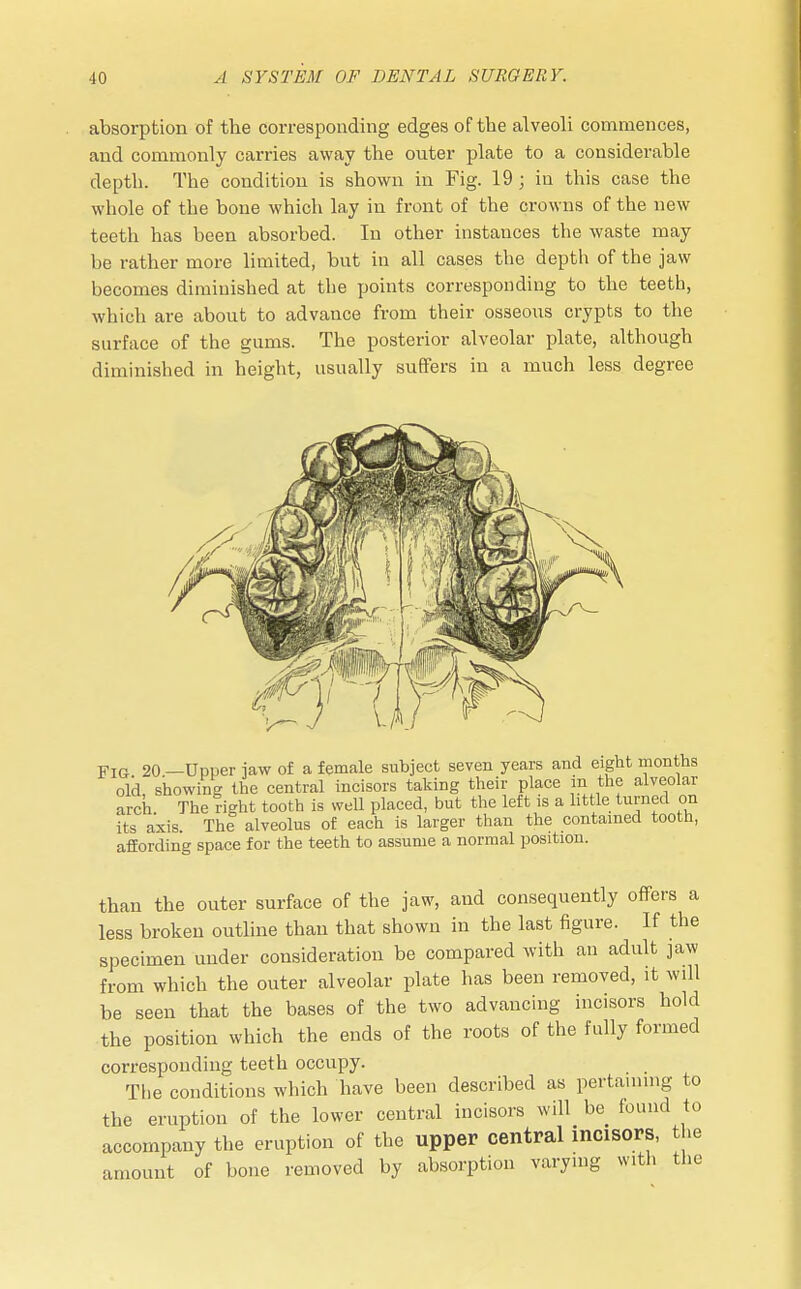 absorption of the corresponding edges of the alveoli commences, and commonly carries away the outer plate to a considerable depth. The condition is shown in Fig. 19; in this case the whole of the bone which lay in front of the crowns of the new teeth has been absorbed. In other instances the waste may be rather more limited, but in all cases the depth of the jaw becomes diminished at the points corresponding to the teeth, which are about to advance from their osseous crypts to the surface of the gums. The posterior alveolar plate, although diminished in height, usually suffers in a much less degree Fig 20 —Upper jaw of a female subject seven years and eight months old, showing the central incisors taking their place m the alveolar arch The right tooth is well placed, but the left is a little turned on its axis. The alveolus of each is larger than the contained tooth, affording space for the teeth to assume a normal position. than the outer surface of the jaw, and consequently offers a less broken outline than that shown in the last figure. If the specimen under consideration be compared with an adult jaw from which the outer alveolar plate has been removed, it wdl be seen that the bases of the two advancing incisors hold the position which the ends of the roots of the fully formed corresponding teeth occupy. The conditions which have been described as pertaining to the eruption of the lower central incisors will be found to accompany the eruption of the upper central mcisors, the amount of bone removed by absorption varying with the