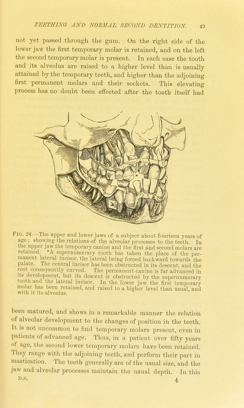 not yet passed through the gum. On the right side of the lower jaw the first temporary molar is retained, and on the left the second temporary molar is present. In each case the tooth and its alveolus are raised to a higher level than is usually attained by the temporary teeth, and higher than the adjoining first permanent molars and their sockets. This elevating process has no doubt been effected after the tooth itself had ig. 24.—The upper and lower jaws of a subject about fourteen years of age ; sbowiDg the relations of the alveolar processes to the teeth. In the upper jaw the temporary canine and the first and second molars are retained. *A supernumerary tooth has taken the place of the per- manent lateral incisor, the lateral being forced backward towards the palate. The central incisor has been obstructed in its descent, and the root consequently curved. The permanent canine is far advanced in its development, but its descent is obstructed by the supernumerary tooth and the lateral incisor. In the lower jaw the first temporary molar has been retained, and raised to a higher level than usual, and with it its alveolus. been matured, and shows in a remarkable manner the relation of alveolar development to the changes of position in the teeth. It is not uncommon to find temporary molars present, even in patients of advanced age. Tims, in a patient over fifty years of age, the second lower temporary molars have been retained. They range with the adjoining teeth, and perform their part in mastication. The teeth generally are of the usual size, and the jaw and alveolar processes maintain the usual depth. In this