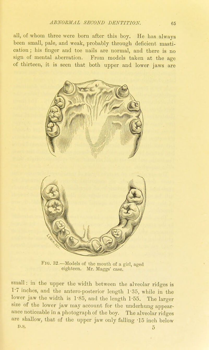 all, of whom three were born after this boy. He has always been small, pale, and weak, probably through deficient masti- cation ; bis finger and toe nails are normal, and there is no sign of mental aberration. From models taken at the age of thirteen, it is seen that both upper and lower jaws are Fig. 32.—Models of the mouth of a girl, aged eighteen. Mr. Maggs' case. small: in the upper the width between the alveolar ridges is 1*7 inches, and the antero-posterior length 1*35, while in the lower jaw the width is 1-85, and the length 1-55. The larger size of the lower jaw may account for the underhung appear- ance noticeable in a photograph of the boy. The alveolar ridges are shallow, that of the upper jaw only falling -15 inch below P.s, 5
