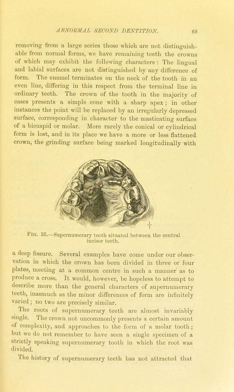 removing from a large series those which are not distinguish- able from normal forms, we. have remaining teeth the crowns of which may exhibit the following characters : The lingual and labial surfaces are not distinguished by any difference of form. The enamel terminates on the neck of the tooth in an even line, differing in this respect from the terminal line in ordinary teeth. The crown of the tooth in the majority of cases presents a simple cone with a sharp apex; in other instances the point will be replaced by an irregularly depressed surface, corresponding in character to the masticating surface of a bicuspid or molar. More rarely the conical or cylindrical form is lost, and in its place we have a more or less flattened crown, the grinding surface being marked longitudinally with Fig. 35.—Supernumerary tooth situated between the central incisor teeth. a deep fissure. Several examples have come under our obser- vation in which the crown has been divided in three or four plates, meeting at a common centre in such a manner as to produce a cross. It would, however, be hopeless to attempt to describe more than the general characters of supernumerary teeth, inasmuch as the minor differences of form are infinitely varied; no two are precisely similar. The roots of supernumerary teeth are almost invariably single. The crown not uncommonly presents a certain amount of complexity, and approaches to the form of a molar tootli; but wc do not remember to have seen a single specimen of a strictly speaking supernumerary tooth in which the root was divided. The history of supernumerary teeth has not attracted that