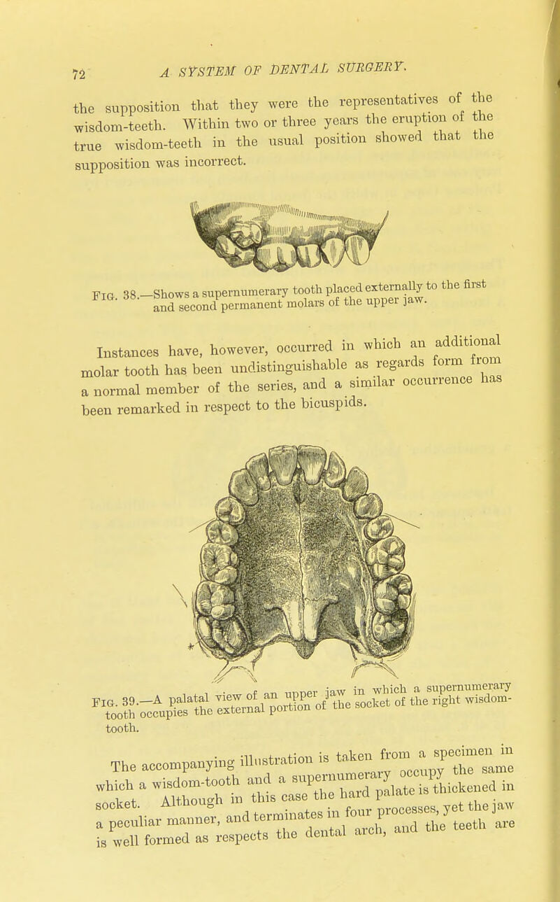 the supposition that they were the representatives wisdom-teeth. Within two or three years the eruption true wisdom-teeth in the usual position showed th supposition was incorrect. Fig 38 -Shows a supernumerary tooth placed externally to the first Second permanent molars of the upper ]aw. Instances have, however, occurred in which an additional molar tooth has been undistinguishable as regards form from a normal member of the series, and a similar occurrence has been remarked in respect to the bicuspids. tooth. tot Although in this case the naia pai»uc « socket. Aitnou^ii ,.m(1„,ses yet the law a peculiar manner, and —ZFanil teeth are is well formed as respects the dental arm, an