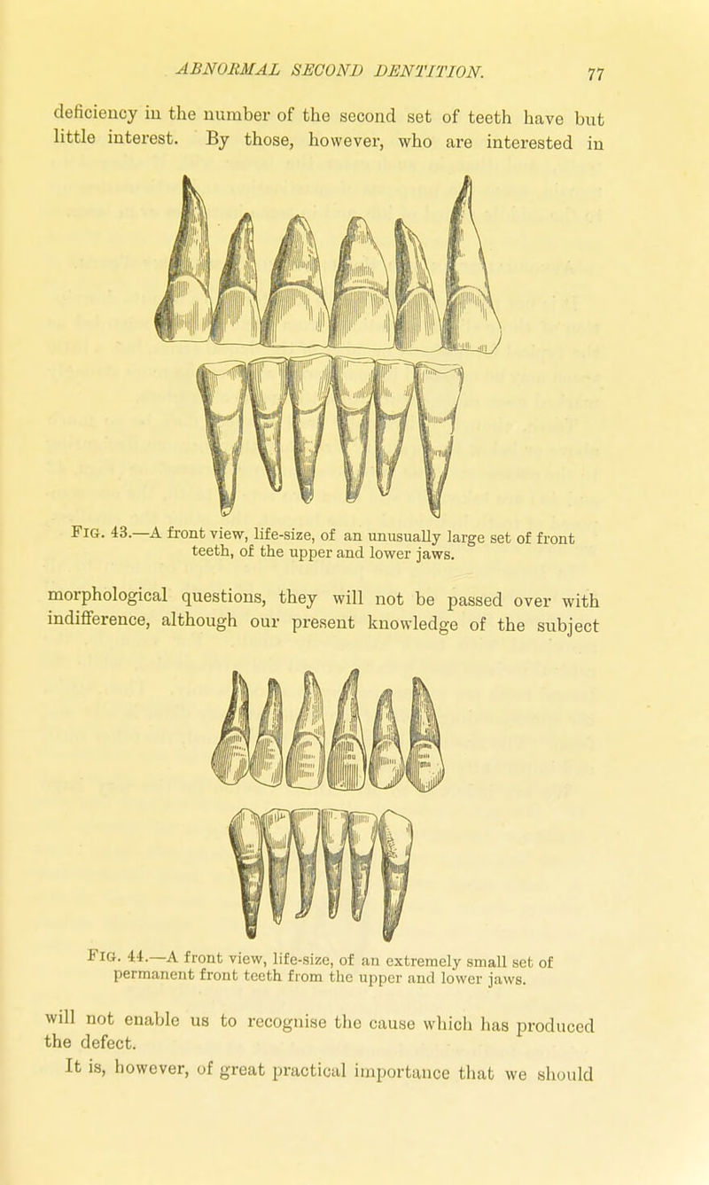 deficiency in the number of the second set of teeth have but little interest. By those, however, who are interested in Fig. 43.—A front view, life-size, of an unusually large set of front teeth, of the upper and lower jaws. morphological questions, they will not be passed over with indifference, although our present knowledge of the subject Fig. U.~A front view, life-size, of an extremely small set of permanent front teeth from the upper and lower jaws. will not enable us to recognise the cause which has produced the defect. It is, however, of great practical importance that we should