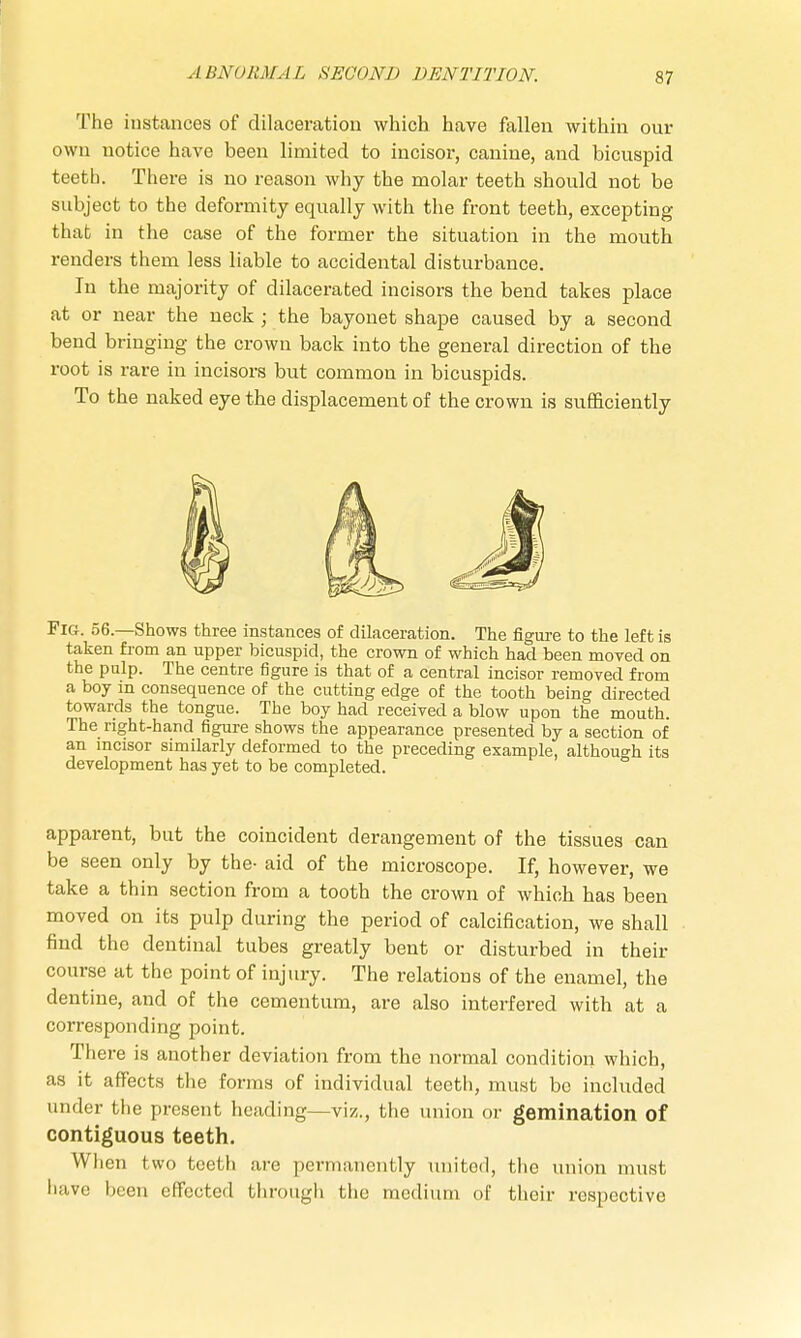The instances of dilaceration which have fallen within our own notice have been limited to incisor, canine, and bicuspid teeth. There is no reason why the molar teeth should not be subject to the deformity equally with the front teeth, excepting that in the case of the former the situation in the mouth renders them less liable to accidental disturbance. In the majority of dilacerated incisors the bend takes place at or near the neck; the bayonet shape caused by a second bend bringing the crown back into the general direction of the root is rare in incisors but common in bicuspids. To the naked eye the displacement of the crown is sufficiently Fig. 56—Shows three instances of dilaceration. The figure to the left is taken from an upper bicuspid, the crown of which had been moved on the pulp. The centre figure is that of a central incisor removed from a boy in consequence of the cutting edge of the tooth being directed towards the tongue. The boy had received a blow upon the mouth. The right-hand figure shows the appearance presented by a section of an incisor similarly deformed to the preceding example, although its development has yet to be completed. apparent, but the coincident derangement of the tissues can be seen only by the- aid of the microscope. If, however, we take a thin section from a tooth the crown of which has been moved on its pulp during the period of calcification, we shall find the dentinal tubes greatly bent or disturbed in their course at the point of injury. The relations of the enamel, the dentine, and of the cementum, are also interfered with at a corresponding point. There is another deviation from the normal condition which, as it affects the forms of individual teeth, must be included under the present heading—viz., the union or gemination of contiguous teeth. When two teeth are permanently united, the union must have been effected through the medium of their respective