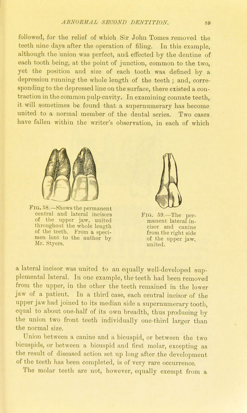 followed, for the relief of which Sir John Tomes removed the teeth nine days after the operation of filing. In this example, although the union was perfect, and effected by the dentine of each tooth being, at the point of junction, common to the two, yet the position and size of each tooth was defined by a depression running the whole length of the teeth; and, corre- sponding to the depressed line on the surface, there existed a con- traction in the common pulp-cavity. In examining connate teeth, it will sometimes be found that a supernumerary has become united to a normal member of the dental series. Two cases, have fallen within the writer's observation, in each of which Fig. 58.—Shows the permanent central and lateral incisors of the upper jaw, united throughout the whole length of the teeth. From a speci- men lent to the author by- Mr. Styers. Fig. 59.—The per- manent lateral in- cisor and canine from the right side of the upper jaw, united. a lateral incisor was united to an equally well-developed sup- plemental lateral. In one example, the teeth had been removed from the upper, in the other the teeth remained in the lower jaw of a patient. In a third case, each central incisor of the upper jaw had joined to its median side a supernumerary tooth, equal to about one-half of its own breadth, thus producing by the union two front teeth individually one-third larger than the normal size. Union between a canine and a bicuspid, or between the two bicuspids, or between a bicuspid and first molar, excepting as the result of diseased action set up long after the development of the teeth has been completed, is of very rare occurrence. The molar teeth are not, however, equally exempt from a