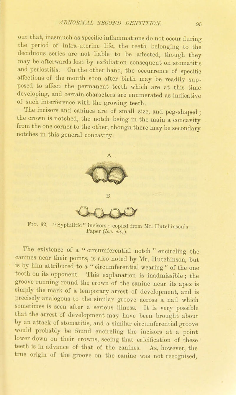 out that, inasmuch as specific inflammations do uot occur during the period of intra-uterine life, the teeth belonging to the deciduous series are not liable to be affected, though they may be afterwards lost by exfoliation consequent on stomatitis and periostitis. On the other hand, the occurrence of specific affections of the mouth soon after birth may be readily sup- posed to affect the permanent teeth which are at this time developing, and certain characters are enumerated as indicative of such interference with the growing teeth. The incisors and canines are of small size, and peg-shaped; the crown is notched, the notch being in the main a concavity from the one corner to the other, though there may be secondary notches in this general concavity. A. Fig. 62.— Syphilitic  incisors ; copied from Mr. Hutchinson's Paper Que. cit.). The existence of a  circumferential notch  encircling the canines near their points, is also noted by Mr. Hutchinson, but is by him attributed to a circumferential wearing of the one tooth on its opponent. This explanation is inadmissible; the groove running round the crown of the canine near its apex is simply the mark of a temporary arrest of development, and is precisely analogous to the similar groove across a nail which sometimes is seen after a serious illness. It is very possible that the arrest of development may have been brought about by an attack of stomatitis, and a similar circumferential groove would probably be found encircling the incisors at a point lower down on their crowns, seeing that calcification of these teeth is in advance of that of the canines. As, however, the true origin of the groove on the canine was not recognised,