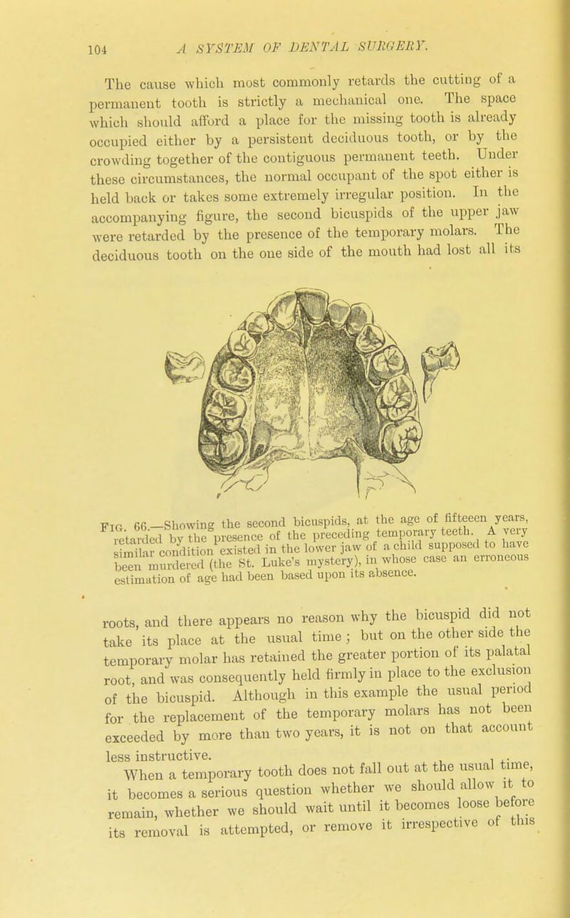 The cause which most commonly retards the cutting of a permanent tooth is strictly a mechanical one. The space which should afford a place for the missing tooth is already occupied either by a persistent deciduous tooth, or by the crowding together of the contiguous permanent teeth. Under these circumstances, the normal occupant of the spot either is held back or takes some extremely irregular position. In the accompanying figure, the second bicuspids of the upper jaw were retarded by the presence of the temporary molars. The deciduous tooth on the one side of the mouth had lost all its FlG 56 Showing the second bicuspids, at the age of fifteeen years, retarded bypresence of the preceding temporary teeth A very S - lUi-n existed in the lower jaw of a child supposed to have be^ muXed(the St. Luke's mystery), in whose case an erroneous estimation of age had been based upon its absence. roots, and there appears no reason why the bicuspid did not take its place at the usual time ; but on the other side the temporary molar has retained the greater portion of its palatal root, and was consequently held firmly in place to the exclusion of the bicuspid. Although in this example the usual period for the replacement of the temporary molars has not been exceeded by more than two years, it is not on that account less instructive. When a temporary tooth does not fall out at the usual time, it becomes a serious question whether we should allow it to remain, whether we should wait until it becomes loose before its removal is attempted, or remove it irrespective of tins