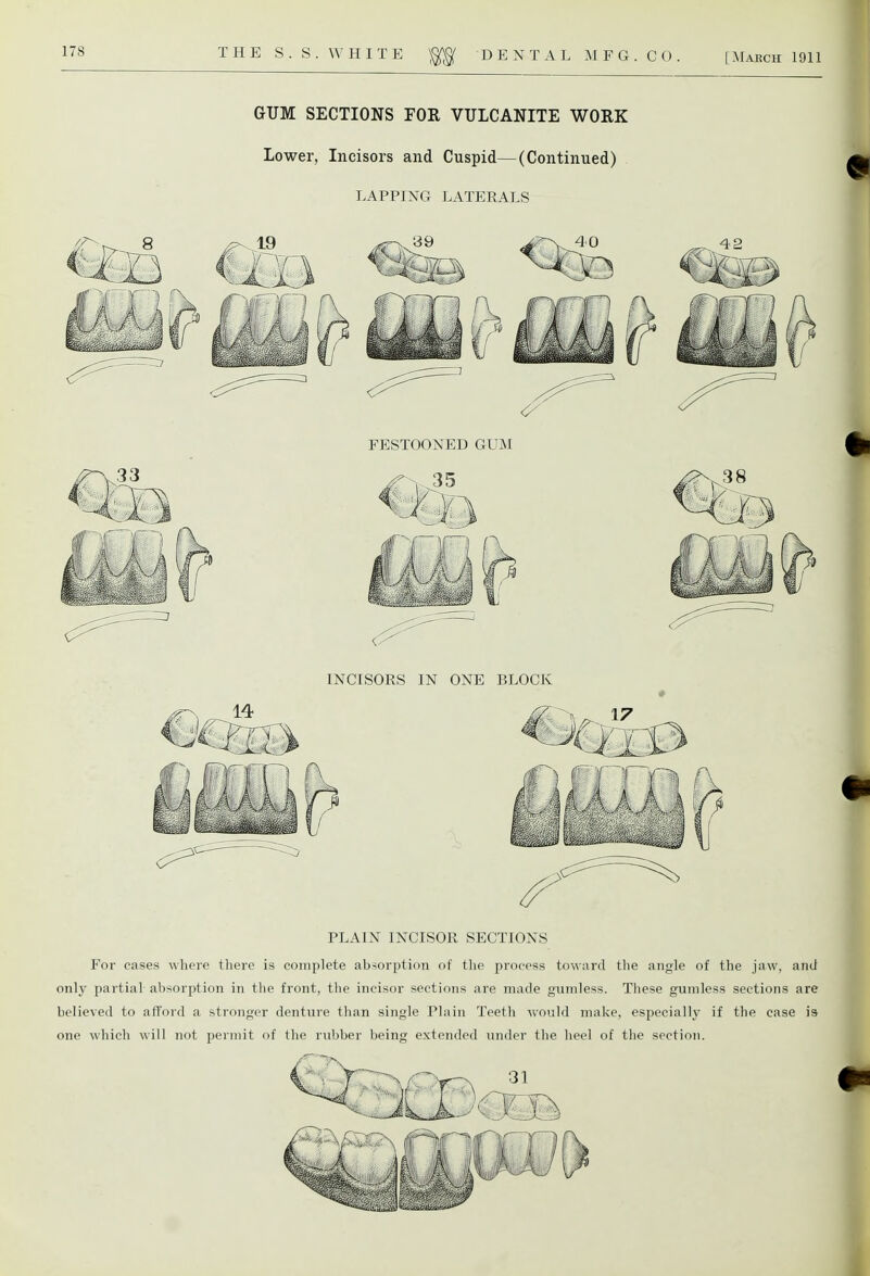 [March 1911 GUM SECTIONS FOR VULCANITE WORK Lower, Incisors and Cuspid—(Continued) LAPPING LATERALS 39 FESTOONED GUM INCISORS IN ONE BLOCK PLAIN INCISOR SECTIONS For cases where there is complete absorption of the process toward the angle of the jaw, and only partial absorption in the front, the incisor sections are made gumless. These gumless sections are believed to afford a stronger denture than single Plain Teeth would make, especially if the case is one which will not permit of the rubber being extended under the heel of the section. 31 f '«r X