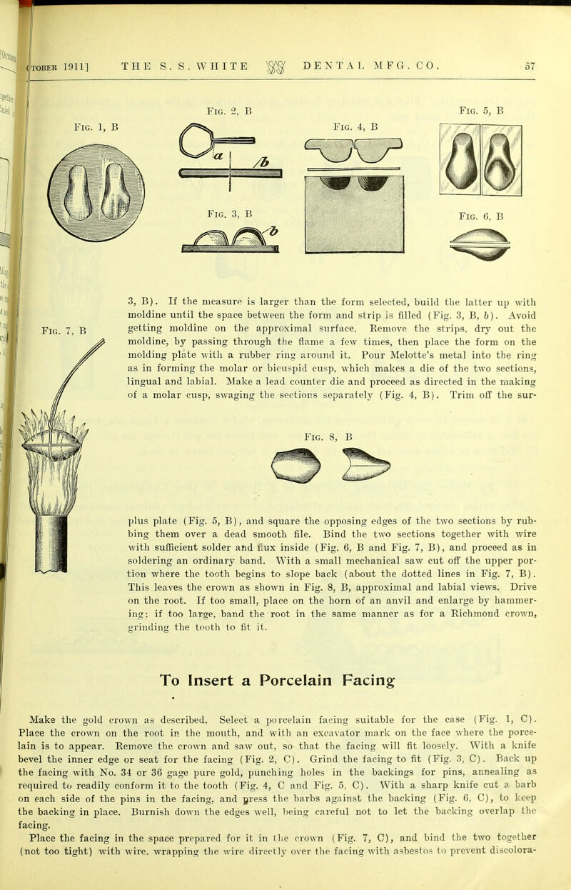 Fig. 2, B Fig. 1, B Fig. 4, B Fig. 3, B Fig. 5, B Fig. 6, B Fig. 7, B 3, B). If the measure is larger than the form selected, build the latter up with moldine until the space between the form and strip is filled (Fig. 3, B, b). Avoid getting moldine on the approximal surface. Remove the strips, dry out the moldine, by passing through the flame a few times, then place the form on the molding plate with a rubber ring around it. Pour Melotte's metal into the ring as in forming the molar or bicuspid cusp, which makes a die of the two sections, lingual and labial. Make a lead counter die and proceed as directed in the making of a molar cusp, swaging the sections separately (Fig. 4, B). Trim off the sur- Fig. 8, B plus plate (Fig. 5, B), and square the opposing edges of the two sections by rub- bing them over a dead smooth file. Bind the two sections together with wire with sufficient solder and llux inside (Fig. 6, B and Fig. 7, B), and proceed as in soldering an ordinary band. With a small mechanical saw cut off the upper por- tion where the tooth begins to slope back (about the dotted lines in Fig. 7, B). This leaves the crown as shown in Fig. 8, B, approximal and labial views. Drive on the root. If too small, place on the horn of an anvil and enlarge by hammer- ing; if too large, band the root in the same manner as for a Richmond crown, grinding the tooth to fit it. To Insert a Porcelain Facing Make the gold crown as described. Select a porcelain facing suitable for the case (Fig. 1, C). Place the crown on the root in the mouth, and with an excavator mark on the face where the porce- lain is to appear. Remove the crown and saw out, so that the facing will fit loosely. With a knife bevel the inner edge or seat for the facing (Fig. 2, C). Grind the facing to fit (Fig. 3, C). Back up the facing with No. 34 or 36 gage pure gold, punching holes in the backings for pins, annealing as required to readily conform it to the tooth (Fig. 4, C and Fig. 5, C). With a sharp knife cut a barb on each side of the pins in the facing, and press the barbs against the backing (Fig. 6, C), to keep the backing in place. Burnish down the edges well, being careful not to let the backing overlap the facing. Place the facing in the space prepared for it in the crown (Fig. 7, C), and bind the two together (not too tight) with wire, wrapping the wire directly over the facing with asbestos to prevent discolora-