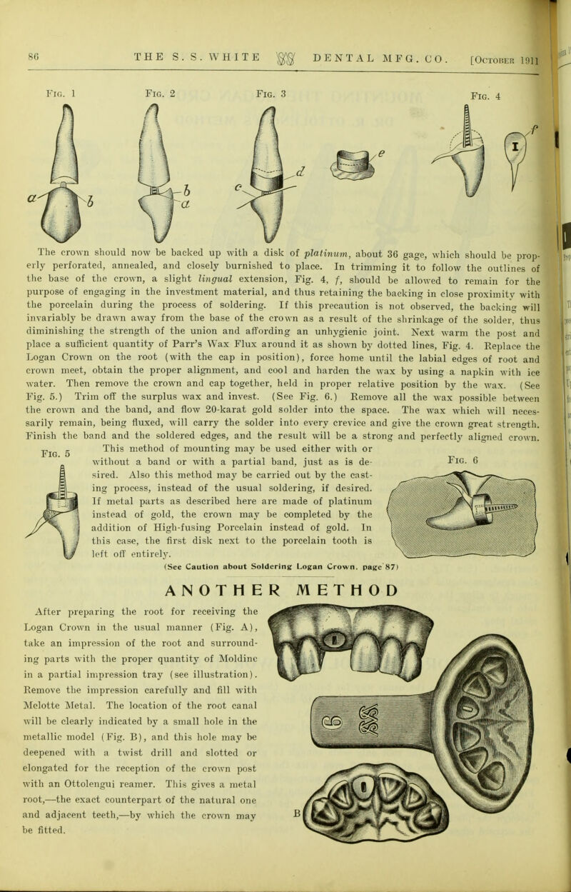 DENTAL MFG. CO. [October 1911 Fig. 1 Fig. 2 Fig. 3 Fig. 4 The crown should now be backed up with a disk of platinum, about 36 gage, which should be prop- erly perforated, annealed, and closely burnished to place. In trimming it to follow the outlines of the base of the crown, a slight lingual extension, Fig. 4, f, should be allowed to remain for the purpose of engaging in the investment material, and thus retaining the backing in close proximity with the porcelain during the process of soldering. If this precaution is not observed, the backing will invariably be drawn away from the base of the crown as a result of the shrinkage of the solder, thus diminishing the strength of the union and affording an unhygienic joint. Next warm the post and place a sufficient quantity of Parr's Wax Flux around it as shown by dotted lines, Fig. 4. Replace the Logan Crown on the root (with the cap in position), force home until the labial edges of root and crown meet, obtain the proper alignment, and cool and harden the wax by using a napkin with ice water. Then remove the crown and cap together, held in proper relative position by the wax. (See Fig. 5.) Trim off the surplus wax and invest. (See Fig. 6.) Remove all the wax possible between the crown and the band, and flow 20-karat gold solder into the space. The wax which will neces- sarily remain, being fluxed, will carry the solder into every crevice and give the crown great strength. Finish the band and the soldered edges, and the result will be a strong and perfectly aligned crown. This method of mounting may be used either with or without a band or with a partial band, just as is de- sired. Also this method may be carried out by the cast- ing process, instead of the usual soldering, if desired. If metal parts as described here are made of platinum instead of gold, the crown may be completed by the addition of High-fusing Porcelain instead of gold. In this case, the first disk next to the porcelain tooth is left off entirely. Fig. 5 Fig ' \_ (See Caution about Soldering Logan Crown, page 87) ANOTHER METHOD After preparing the root for receiving the Logan Crown in the usual manner (Fig. A), take an impression of the root and surround- ing parts with the proper quantity of Moldine in a partial impression tray (see illustration). Remove the impression carefully and fill with Melotte Metal. The location of the root canal will be clearly indicated by a small hole in the metallic model (Fig. B), and this hole may be deepened with a twist drill and slotted or elongated for the reception of the crown post with an Ottolengui reamer. This gives a metal root,—the exact counterpart of the natural one and adjacent teeth,—by which the crown may be fitted.