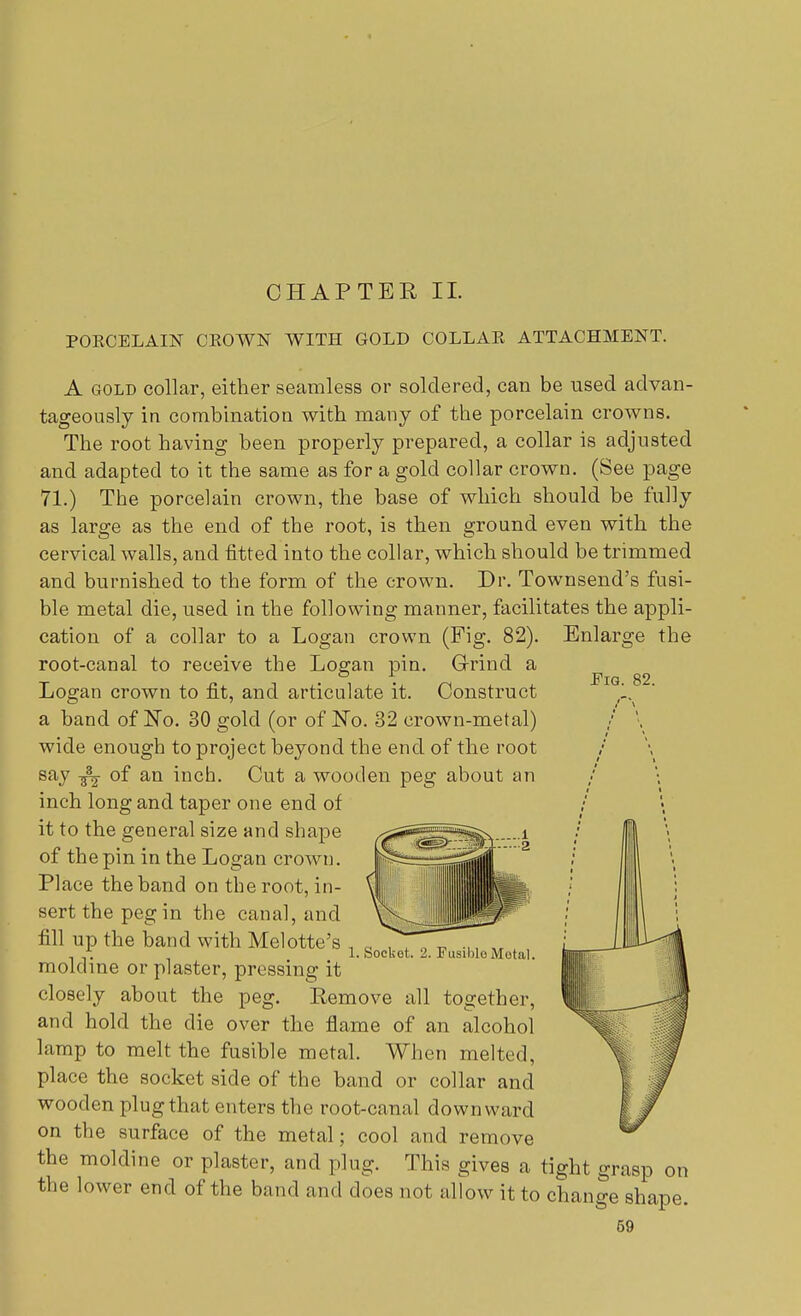 CHAPTER II. PORCELAIN CROWN WITH GOLD COLLAR ATTACHMENT. Pig. 82. A gold collar, either seamless or soldered, can be used advan- tageously in combination with many of the porcelain crowns. The root having been properly prepared, a collar is adjusted and adapted to it the same as for a gold collar crown. (See page 71.) The porcelain crown, the base of which should be fully as large as the end of the root, is then ground even with the cervical walls, and fitted into the collar, which should be trimmed and burnished to the form of the crown. Dr. Townsend's fusi- ble metal die, used in the following manner, facilitates the appli- cation of a collar to a Logan crown (Fig. 82). Enlarge the root-canal to receive the Logan pin. Grind a Logan crown to fit, and articulate it. Construct a band of No. 30 gold (or of No. 32 crown-metal) wide enough to project beyond the end of the root say of an inch. Cut a wooden peg about an inch long and taper one end of it to the general size and shape of the pin in the Logan crown. Place the band on the root, in- sert the peg in the canal, and fill up the band with Melotte's 1 s moldine or plaster, pressing it closely about the peg. Remove all together, and hold the die over the flame of an alcohol lamp to melt the fusible metal. When melted, place the socket side of the band or collar and wooden plug that enters the root-canal downward on the surface of the metal; cool and remove the moldine or plaster, and plug. This gives a tight grasp . the lower end of the band and docs not allow it to change shape 59 , Socket. 2. FusibloMotal. on