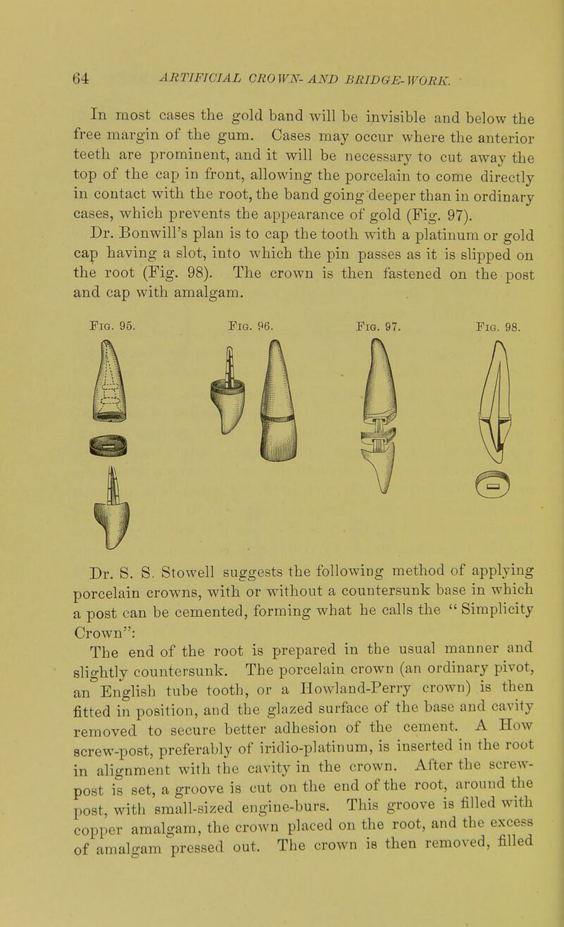 In most cases the gold band will be invisible and below the free margin of the gum. Cases may occur where the anterior teeth are prominent, and it will be necessary to cut away the top of the cap in front, allowing the porcelain to come directly in contact with the root, the band going deeper than in ordinary cases, which prevents the appearance of gold (Fig. 97). Dr. Bonwill's plan is to cap the tooth with a platinum or gold cap having a slot, into which the pin passes as it is slipped on the root (Fig. 98). The crown is then fastened on the post and cap with amalgam. Fig. 95. Fig. 96. Fig. 97. Fig. 98. Dr. S. S. Stowell suggests the following method of applying porcelain crowns, with or without a countersunk base in which a post can be cemented, forming what he calls the  Simplicity Crown: The end of the root is prepared in the usual manner and slightly countersunk. The porcelain crown (an ordinary pivot, an English tube tooth, or a Howland-Perry crown) is then fitted in position, and the glazed surface of the base and cavity removed to secure better adhesion of the cement, A How screw-post, preferably of iridio-platinum, is inserted in the root in alignment with the cavity in the crown. After the screw- post is set, a groove is cut on the end of the root, around the post, with small-sized engine-burs. This groove is filled with copper amalgam, the crown placed on the root, and the excess of amalgam prised out. The crown is then removed, filled