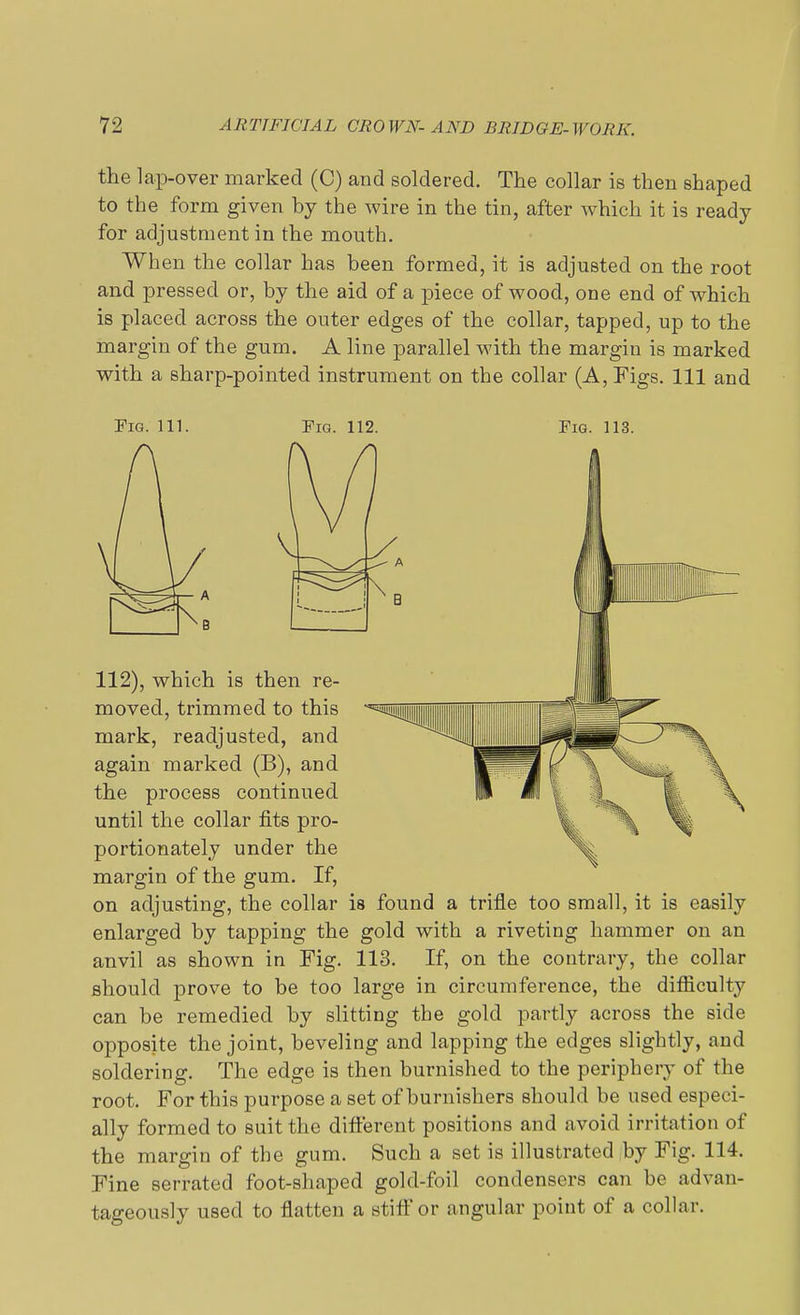 the lap-over marked (C) and soldered. The collar is then shaped to the form given by the wire in the tin, after which it is ready for adjustment in the mouth. When the collar has been formed, it is adjusted on the root and pressed or, by the aid of a piece of wood, one end of which is placed across the outer edges of the collar, tapped, up to the margin of the gum. A line parallel with the margin is marked with a sharp-pointed instrument on the collar (A, Figs. Ill and Pig. in. Pig. 112. Pig. 113. 112), which is then re- moved, trimmed to this mark, readjusted, and again marked (B), and the process continued until the collar fits pro- portionately under the margin of the gum. If, on adjusting, the collar is found a trifle too small, it is easily enlarged by tapping the gold with a riveting hammer on an anvil as shown in Fig. 113. If, on the contrary, the collar should prove to be too large in circumference, the difficulty can be remedied by slitting the gold partly across the side opposite the joint, beveling and lapping the edges slightly, and soldering. The edge is then burnished to the periphery of the root. For this purpose a set of burnishers should be used especi- ally formed to suit the different positions and avoid irritation of the margin of the gum. Such a set is illustrated by Fig. 114. Fine serrated foot-shaped gold-foil condensers can be advan- tageously used to flatten a stiff or angular point of a collar.