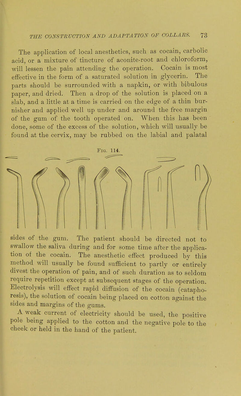 The application of local anesthetics, such as cocain, carbolic acid, or a mixture of tincture of aconite-root and chloroform, will lessen the pain attending the operation. Cocain is most effective in the form of a saturated solution in glycerin. The parts should be surrounded with a napkin, or with bibulous paper, and dried. Then a drop of the solution is placed on a slab, and a little at a time is carried on the edge of a thin bur- nisher and applied well up under and around the free margin of the gum of the tooth operated on. When this has been done, some of the excess of the solution, which will usually be found at the cervix, may be rubbed on the labial and palatal Pig. 114. sides of the gum. The patient should be directed not to swallow the saliva during and for some time after the applica- tion of the cocain. The anesthetic effect produced by this method will usually be found sufficient to partly or entirely divest the operation of pain, and of such duration as to seldom require repetition except at subsequent stages of the operation. Electrolysis will effect rapid diffusion of the cocain (catapho- resis), the solution of cocain being placed on cotton against the sides and margins of the gums. A weak current of electricity should be used, the positive pole being applied to the cotton and the negative pole to the cheek or held in the hand of the patient.