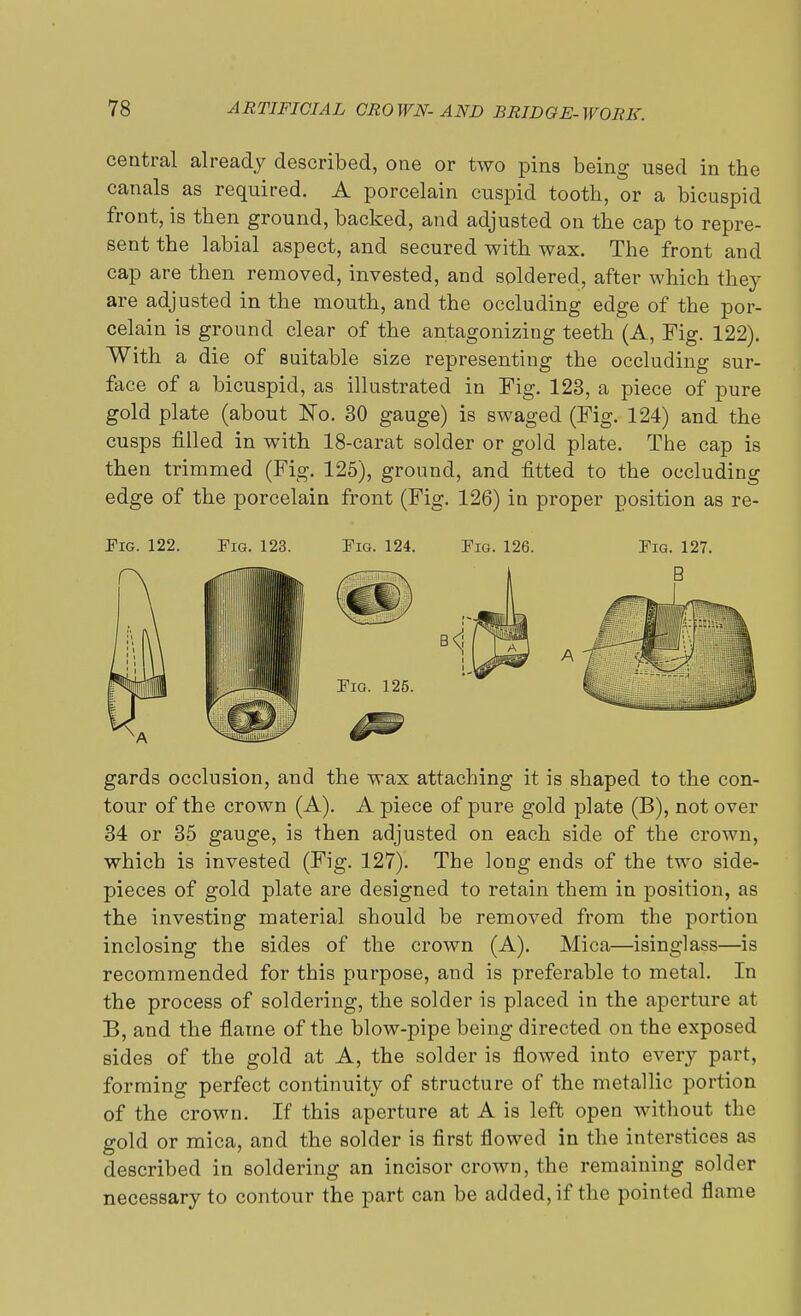 central already described, one or two pins being used in the canals as required. A porcelain cuspid tooth, or a bicuspid front, is then ground, backed, and adjusted on the cap to repre- sent the labial aspect, and secured with wax. The front and cap are then removed, invested, and soldered, after which they are adjusted in the mouth, and the occluding edge of the por- celain is ground clear of the antagonizing teeth (A, Fig. 122). With a die of suitable size representing the occluding sur- face of a bicuspid, as illustrated in Fig. 123, a piece of pure gold plate (about No. 30 gauge) is swaged (Fig. 124) and the cusps filled in with 18-carat solder or gold plate. The cap is then trimmed (Fig. 125), ground, and fitted to the occluding edge of the porcelain front (Fig. 126) in proper position as re- Fig. 122. Fig. 123. Fig. 124. Fig. 126. Fig. 127. gards occlusion, and the wax attaching it is shaped to the con- tour of the crown (A). A piece of pure gold plate (B), not over 34 or 35 gauge, is then adjusted on each side of the crown, which is invested (Fig. 127). The long ends of the two side- pieces of gold plate are designed to retain them in position, as the investing material should be removed from the portion inclosing the sides of the crown (A). Mica—isinglass—is recommended for this purpose, and is preferable to metal. In the process of soldering, the solder is placed in the aperture at B, and the flame of the blow-pipe being directed on the exposed sides of the gold at A, the solder is flowed into every part, forming perfect continuity of structure of the metallic portion of the crown. If this aperture at A is left open without the gold or mica, and the solder is first flowed in the interstices as described in soldering an incisor crown, the remaining solder necessary to contour the part can be added, if the pointed flame