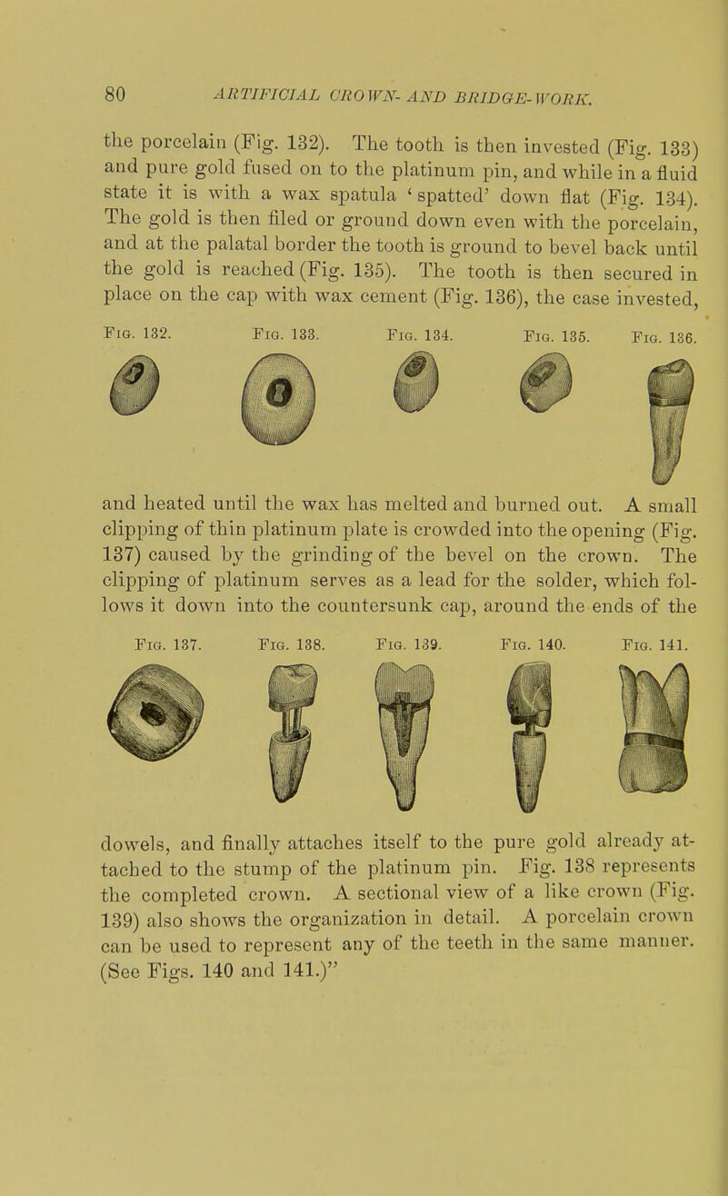 the porcelain (Fig. 132). The tooth is then invested (Fig. 133) and pure gold fused on to the platinum pin, and while in a fluid state it is with a wax spatula 'spatted' down flat (Fig. 134). The gold is then filed or ground down even with the porcelain, and at the palatal border the tooth is ground to bevel back until the gold is reached (Fig. 135). The tooth is then secured in place on the cap with wax cement (Fig. 136), the case invested, Fig. 132. Fig. 133. Fig. 134. Fig. 135. Fig. 136. and heated until the wax has melted and burned out. A small clipping of thin platinum plate is crowded into the opening (Fig. 137) caused by the grinding of the bevel on the crown. The clipping of platinum serves as a lead for the solder, which fol- lows it down into the countersunk cap, around the ends of the Fig. 137. Fig. 138. Fig. 139. Fig. 140. dowels, and finally attaches itself to the pure gold already at- tached to the stump of the platinum pin. Fig. 138 represents the completed crown. A sectional view of a like crown (Fig. 139) also shows the organization in detail. A porcelain crown can be used to represent any of the teeth in the same manner. (See Figs. 140 and 141.)