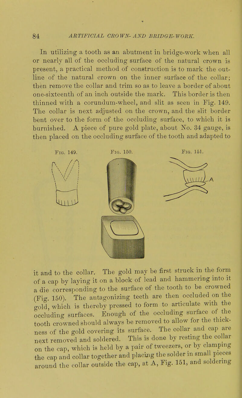 In utilizing a tooth as an abutment in bridge-work when all or nearly all of the occluding surface of the natural crown is present, a practical method of construction is to mark the out- line of the natural crown on the inner surface of the collar; then remove the collar and trim so as to leave a border of about one-sixteenth of an inch outside the mark. This border is then thinned with a corundum-wheel, and slit as seen in Fig. 149. The collar is next adjusted on the crown, and the slit border bent over to the form of the occluding surface, to which it is burnished. A piece of pure gold plate, about ISTo. 34 gauge, is then placed on the occluding surface of the tooth and adapted to Fig. 149. Fig. 150. Fig. 151. it and to the collar. The gold may be first struck in the form of a cap by laying it on a block of lead and hammering into it a die corresponding to the surface of the tooth to be crowned (Fig. 150). The antagonizing teeth are then occluded on the gold which is thereby pressed to form to articulate with the occluding surfaces. Enough of the occluding surface of the tooth crowned should always be removed to allow for the thick- ness of the gold covering its surface. The collar and cap are next removed and soldered. This is done by resting the collar on the cap, which is held by a pair of tweezers, or by clamping the cap and collar together and placing the solder in small pieces around the collar outside the cap, at A, Fig. 151, and soldering