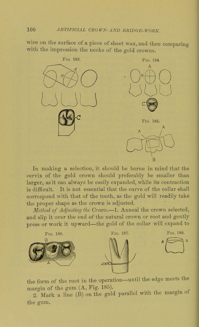 wire on the surface of a piece of sheet wax, and then comparing with the impression the necks of the gold crowns. Fig. 183. pm. 184. B In making a selection, it should he home in mind that the cervix of the gold crown should preferably he smaller than larger, as it can always be easily expanded, while its contraction is difficult. It is not essential that the curve of the collar shall correspond with that of the tooth, as the gold will readily take the proper shape as the crown is adjusted. Method of Adjusting the Crown.—1. Anneal the crown selected, and slip it over the end of the natural crown or root and gently press or work it upward—the gold of the collar will expand to Pig. 186. Fig. 187. Fig. 188. the form of the root in the operation—until the edge meets margin of the gum (A, Fig. 185). 2. Mark a line (B) on the gold parallel with the margi: the gum.