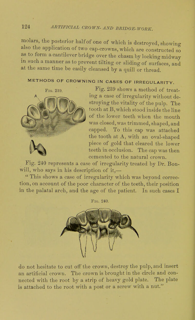 molars, the posterior half of one of which is destroyed, showing also the application of two cap-crowns, which are constructed so as to form a cantilever bridge over the chasm by locking midway m such a manner as to prevent tilting or sliding of surfaces, and at the same time be easily cleansed by a quill or thread. Fig. 239. METHODS OF CROWNING IN CASES OF IRREGULARITY. Fig. 239 shows a method of treat- ing a case of irregularity without de- stroying the vitality of the pulp. The tooth at B, which stood inside the line of the lower teeth when the mouth was closed, was trimmed, shaped, and capped. To this cap was attached the tooth at A, with an oval-shaped piece of gold that cleared the lower teeth in occlusion. The cap was then cemented to the natural crown. Fig. 240 represents a case of irregularity treated by Dr. Bon- wall, who says in his description of it,—  This shows a case of irregularity which was beyond correc- tion, on account of the poor character of the teeth, their position in the palatal arch, and the age of the patient. In such cases I Fig. 240. do not hesitate to cut off the crown, destroy the pulp, and insert an artificial crown. The crown is brought in the circle and con- nected with the root by a strip of heavy gold plate. The plate is attached to the root with a post or a screw with a nut.