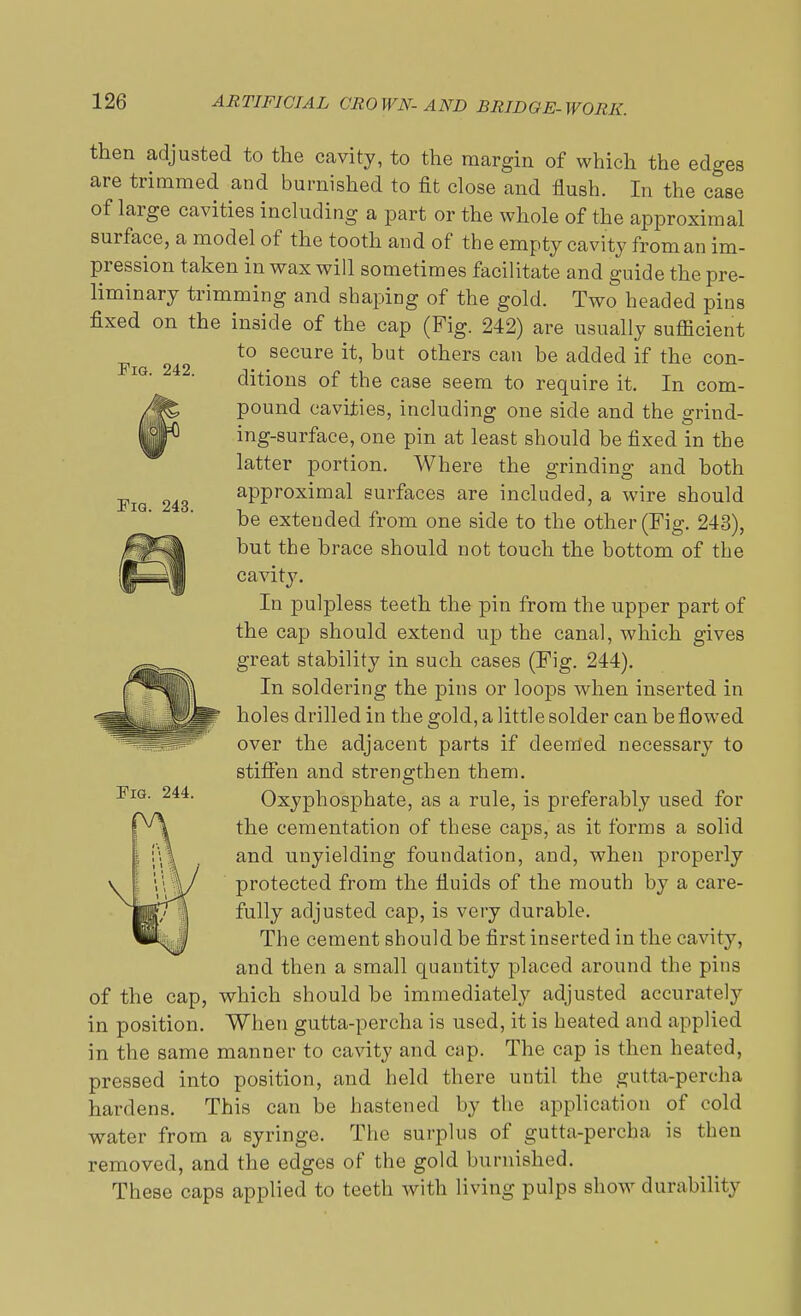 Fig. 242. Fig. 243. then adjusted to the cavity, to the margin of which the edges are trimmed and burnished to fit close and flush. In the case of large cavities including a part or the whole of the approximal surface, a model of the tooth and of the empty cavity from an im- pression taken in wax will sometimes facilitate and guide the pre- liminary trimming and shaping of the gold. Two headed pins fixed on the inside of the cap (Fig. 242) are usually suflicient to secure it, but others can be added if the con- ditions of the case seem to require it. In com- pound cavities, including one side and the grind- mg-surface, one pin at least should be fixed in the latter portion. Where the grinding and both approximal surfaces are included, a wire should be extended from one side to the other (Fig. 243), but the brace should not touch the bottom of the cavity. In pulpless teeth the pin from the upper part of the cap should extend up the canal, which gives great stability in such cases (Fig. 244). In soldering the pins or loops when inserted in holes drilled in the gold, a little solder can be flowed over the adjacent parts if deemed necessary to stiffen and strengthen them. Oxyphosphate, as a rule, is preferably used for the cementation of these caps, as it forms a solid and unyielding foundation, and, when properly protected from the fluids of the mouth by a care- fully adjusted cap, is very durable. The cement should be first inserted in the cavity, and then a small quantity placed around the pins which should be immediately adjusted accurately When gutta-percha is used, it is heated and applied in the same manner to cavity and cap. The cap is then heated, pressed into position, and held there until the gutta-percha hardens. This can be hastened by the application of cold water from a syringe. The surplus of gutta-percha is then removed, and the edges of the gold burnished. These caps applied to teeth with living pulps show durability Fig. 244. of the cap, in position.