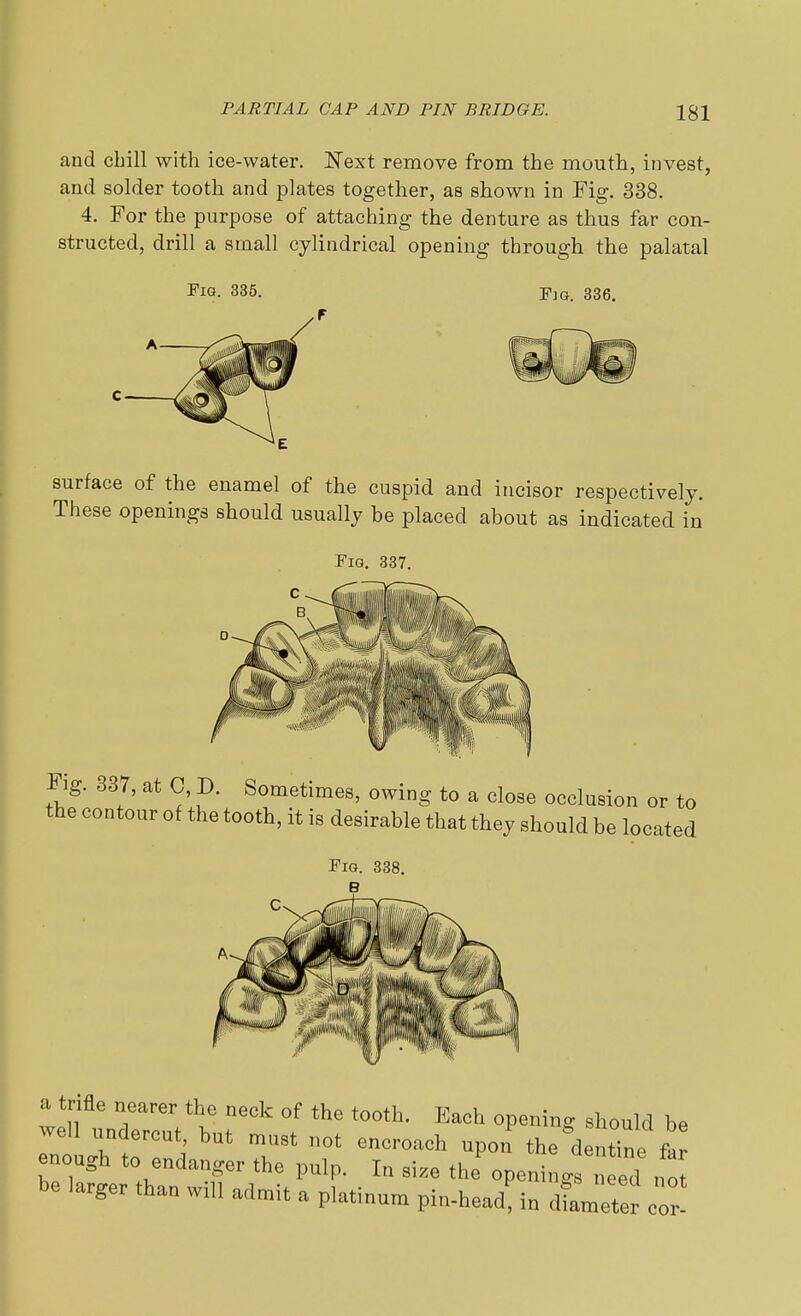 PARTIAL CAP AND PIN BRIDGE. and cbill with ice-water. Next remove from the mouth, invest, and solder tooth and plates together, as shown in Fig. 338. 4. For the purpose of attaching the denture as thus far con- structed, drill a small cylindrical opening through the palatal Fig. 335. Fig. 336. surface of the enamel of the cuspid and incisor respectively. These openings should usually be placed about as indicated in Fig. 337. Fig. 337, at 0, D. Sometimes, owing to a close occlusion or to the contour of the tooth, it is desirable that they should be located a trifle nearer the neck of the tooth. Each opening should be well undercut but must not encroach upon the dentine far enough to endanger the pulp. In size the openings need no be larger than wxll admit a platinum pin-head; in diameter cor