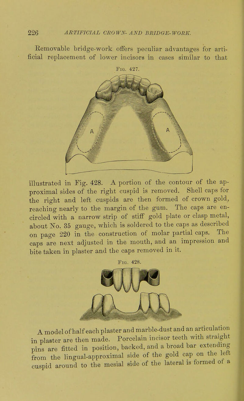 Removable bridge-work offers peculiar advantages for arti- ficial replacement of lower incisors in cases similar to that Pig. 427. illustrated in Fig. 428. A portion of the contour of the ap- proximal sides of the right cuspid is removed. Shell caps for the right and left cuspids are then formed of crown gold, reaching nearly to the margin of the gum. The caps are en- circled with a narrow strip of stiff gold plate or clasp metal, about IsTo. 35 gauge, which is soldered to the caps as described on page 220 in the construction of molar partial caps. The caps are next adjusted in the mouth, and an impression and bite taken in plaster and the caps removed in it. Fig. 428. A model of half each plaster and marble-dust and an articulation in plaster are then made. Porcelain incisor teeth with straight pins are fitted in position, backed, and a broad bar extending from the lingual-approximal side of the gold cap on the left cuspid around to the mesial side of the lateral is formed of a