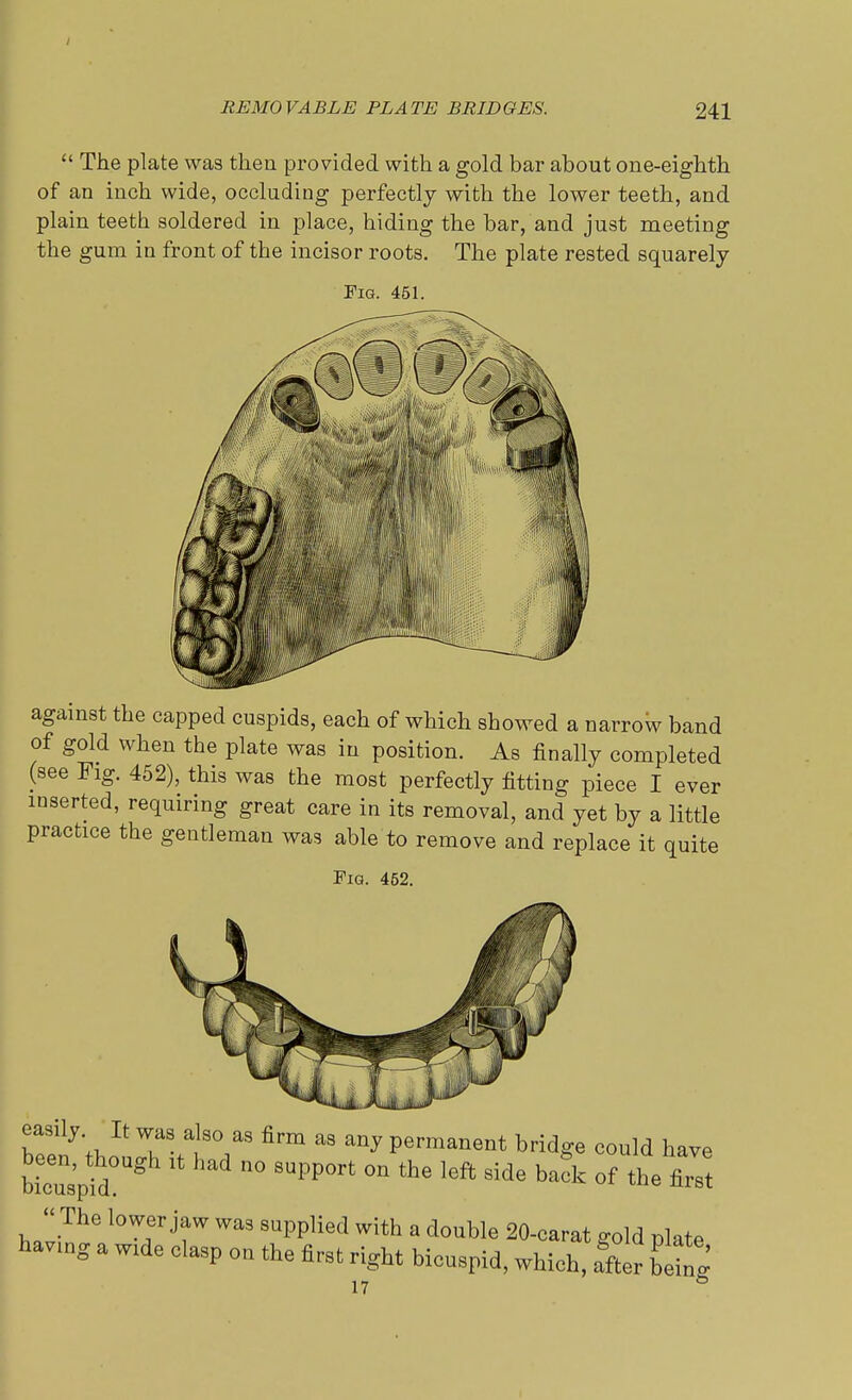  The plate was then provided with a gold bar about one-eighth of an inch wide, occluding perfectly with the lower teeth, and plain teeth soldered in place, hiding the bar, and just meeting the gum in front of the incisor roots. The plate rested squarely Fig. 451. against the capped cuspids, each of which showed a narrow band of gold when the plate was in position. As finally completed (see Fig. 452), this was the most perfectly fitting piece I ever inserted, requiring great care in its removal, and yet by a little practice the gentleman was able to remove and replace it quite Fig. 452. Tf^If 7S tY3 fi™ aS an^ Pe™<»ent bridge could have bieun3'pid°US ^ n° 9UPP°rt °n *e l6ft Side ba* of the first The lower jaw was supplied with a double 20-earat gold plate havug a w.de elasp ou the first right bicuspid, which, tfter bebg