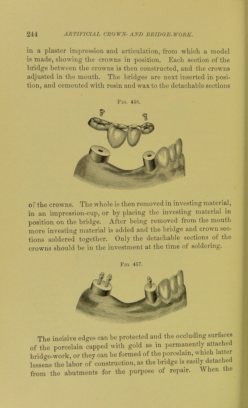 in a plaster impression and articulation, from which a model is made, showing the crowns in position. Each section of the bridge between the crowns is then constructed, and the crowns adjusted in the mouth. The bridges are next inserted in posi- tion, and cemented with resin and wax to the detachable sections Fig. 456. of the crowns. The whole is then removed in investing material, in an impression-cup, or by placing the investing material in position on the bridge. After being removed from the mouth more investing material is added and the bridge and crown sec- tions soldered together. Only the detachable sections of the crowns should be in the investment at the time of soldering. Fig. 457. The incisive edges can be protected and the occluding surfaces of the porcelain capped with gold as in permanently attached bridge-work, or they can be formed of the porcelain, which latter lessens the labor of construction, as the bridge is easily detached from the abutments for the purpose of repair. When the