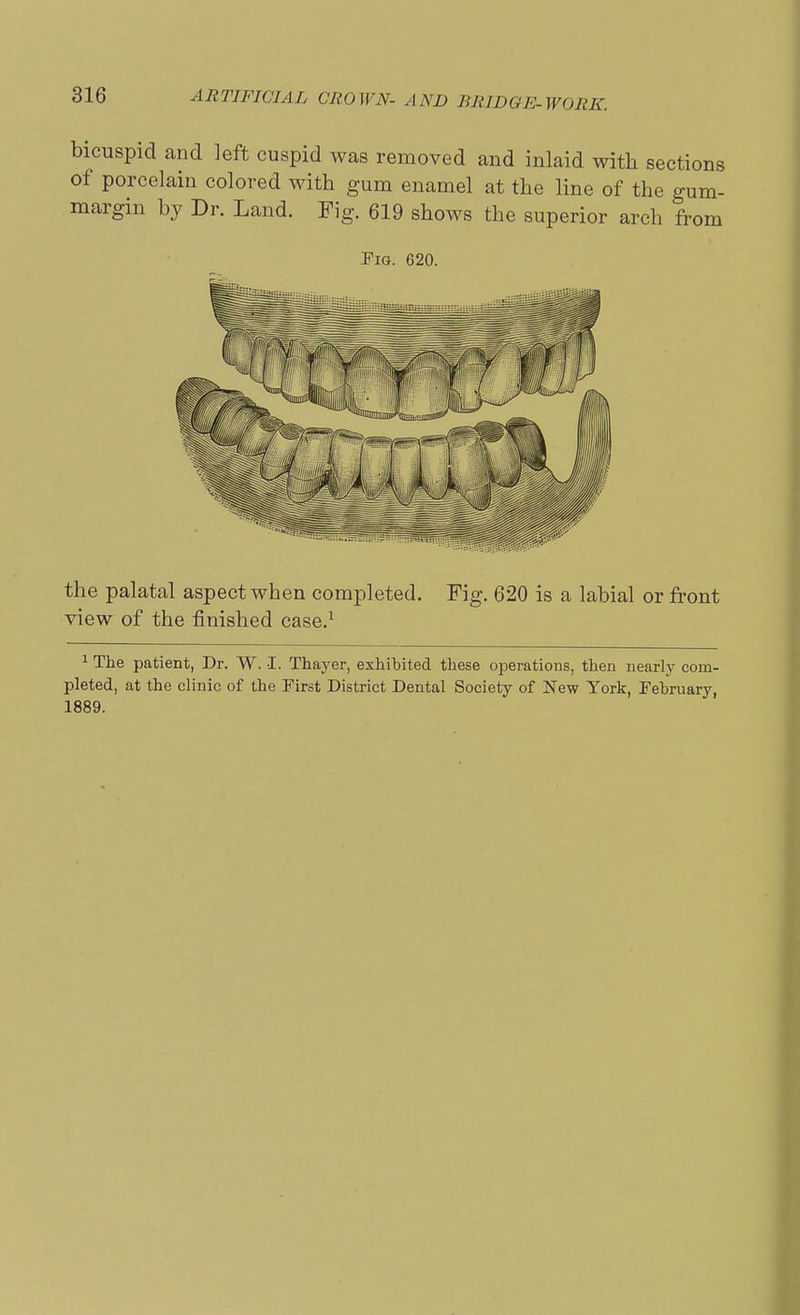 bicuspid and left cuspid was removed and inlaid with sections of porcelain colored with gum enamel at the line of the gum- margin by Dr. Land. Fig. 619 shows the superior arch from Pig. 620. the palatal aspect when completed. Fig. 620 is a labial or front view of the finished case.1 1 The patient, Dr. W. I. Thayer, exhibited these operations, then nearly com- pleted, at the clinic of the First District Dental Society of New York, February, 1889.