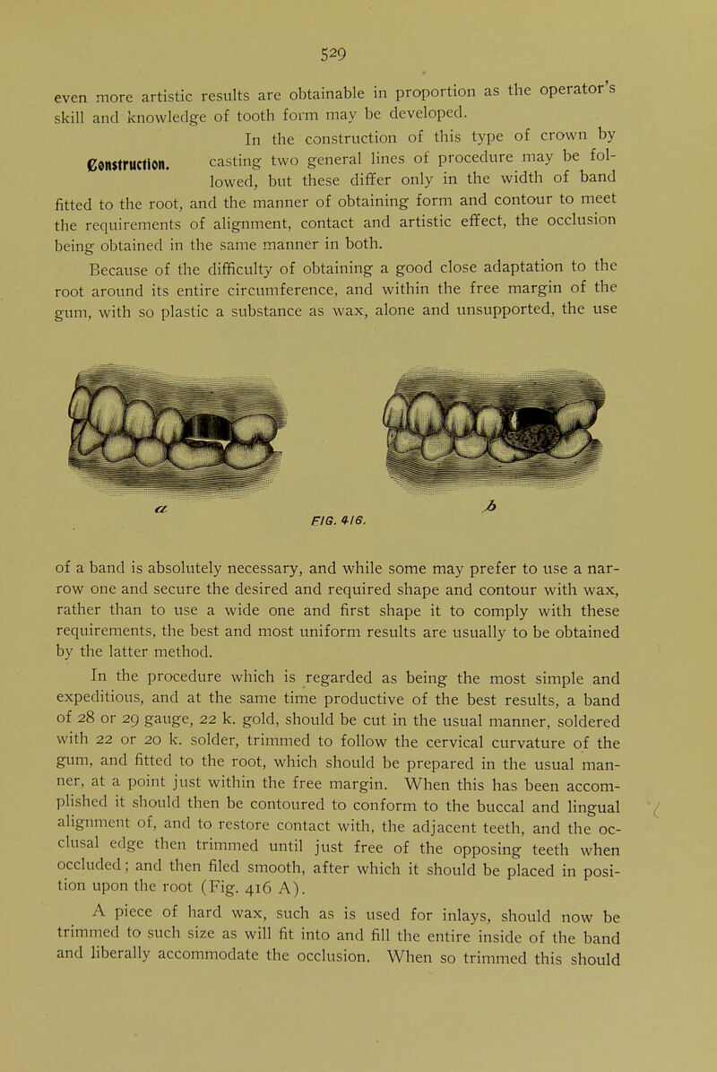 even more artistic results are obtainable in proportion as the operator's skill and knowledge of tooth form may be developed. In the construction of this type of crown by Construction. casting two general lines of procedure may be fol- lowed, but these differ only in the width of band fitted to the root, and the manner of obtaining form and contour to meet the requirements of alignment, contact and artistic effect, the occlusion being obtained in the same manner in both. Because of the difficulty of obtaining a good close adaptation to the root around its entire circumference, and within the free margin of the gum, with so plastic a substance as wax, alone and unsupported, the use FJG. Q-16. of a band is absolutely necessary, and while some may prefer to use a nar- row one and secure the desired and required shape and contour with wax, rather than to use a wide one and first shape it to comply with these requirements, the best and most uniform results are usually to be obtained by the latter method. In the procedure which is regarded as being the most simple and expeditious, and at the same time productive of the best results, a band of 28 or 29 gauge, 22 k. gold, should be cut in the usual manner, soldered with 22 or 20 k. solder, trimmed to follow the cervical curvature of the gum, and fitted to the root, which should be prepared in the usual man- ner, at a point just within the free margin. When this has been accom- plished it should then be contoured to conform to the buccal and lingual alignment of, and to restore contact with, the adjacent teeth, and the oc- clusal edge then trimmed until just free of the opposing teeth when occluded; and then filed smooth, after which it should be placed in posi- tion upon the root (Fig. 416 A). A piece of hard wax, such as is used for inlays, should now be trimmed to such size as will fit into and fill the entire inside of the band and liberally accommodate the occlusion. When so trimmed this should