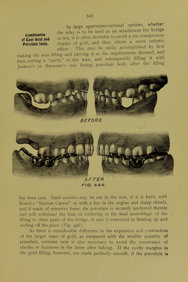 In large approximo-occlusal cavities, whether the inlay is to be used as an attachment for bridge or not it is often desirable to avoid a too conspicuous display of gold, and thus obtain a more esthetic effect. This may be easily accomplished by first making the wax filling and carving it as the requirements demand, and then cutting a cavity in the wax, and subsequently filling it with Jenkins's or Brewster's low fusing porcelain body after the filling Combination of east Gold and Porcelain Inlay. BEFORE A FTER FIG. 4-44-. has been cast. Such cavities may be cut in the wax, if it is hard, with Roach's Suction Carver or with a bur in the engine and sharp chisels, and if made of retentive form, the porcelain is securely anchored therein and will withstand the heat of soldering in the final assemblage of the filling to other parts of the bridge, if care is exercised in heating up and cooling off the piece (Fig. 446). As there is considerable difference in the expansion and contraction of the larger mass of gold, as compared with the smaller quantity of porcelain, extreme care is also necessary to avoid the occurrence of checks or fractures in the latter after baking. If the cavity margins in the gold filling, however, are made perfectly smooth, if the porcelain is