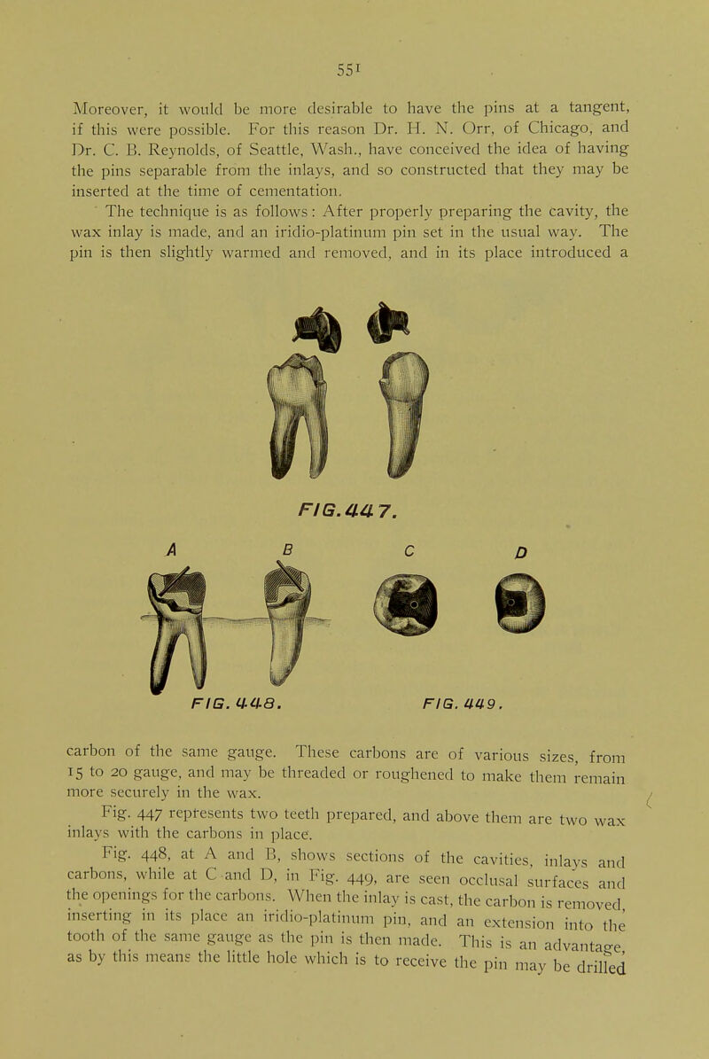 Moreover, it would be more desirable to have the pins at a tangent, if this were possible. For this reason Dr. H. N. Orr, of Chicago, and Dr. C. B. Reynolds, of Seattle, Wash., have conceived the idea of having the pins separable from the inlays, and so constructed that they may be inserted at the time of cementation. The technique is as follows: After properly preparing the cavity, the wax inlay is made, and an iridio-platinum pin set in the usual way. The pin is then slightly warmed and removed, and in its place introduced a FIB.ti.lia. FIG. 449. carbon of the same gauge. These carbons are of various sizes, from 15 to 20 gauge, and may be threaded or roughened to make them remain more securely in the wax. Fig. 447 represents two teeth prepared, and above them are two wax inlays with the carbons in place. Fig. 448, at A and B, shows sections of the cavities, inlays and carbons, while at C and D, in Fig. 449, are seen occlusal surfaces and the openings for the carbons. When the inlay is cast, the carbon is removed inserting in its place an iridio-platinum pin, and an extension into the tooth of the same gauge as the pin is then made. This is an advantage as by this means the little hole which is to receive the pin may be drilled