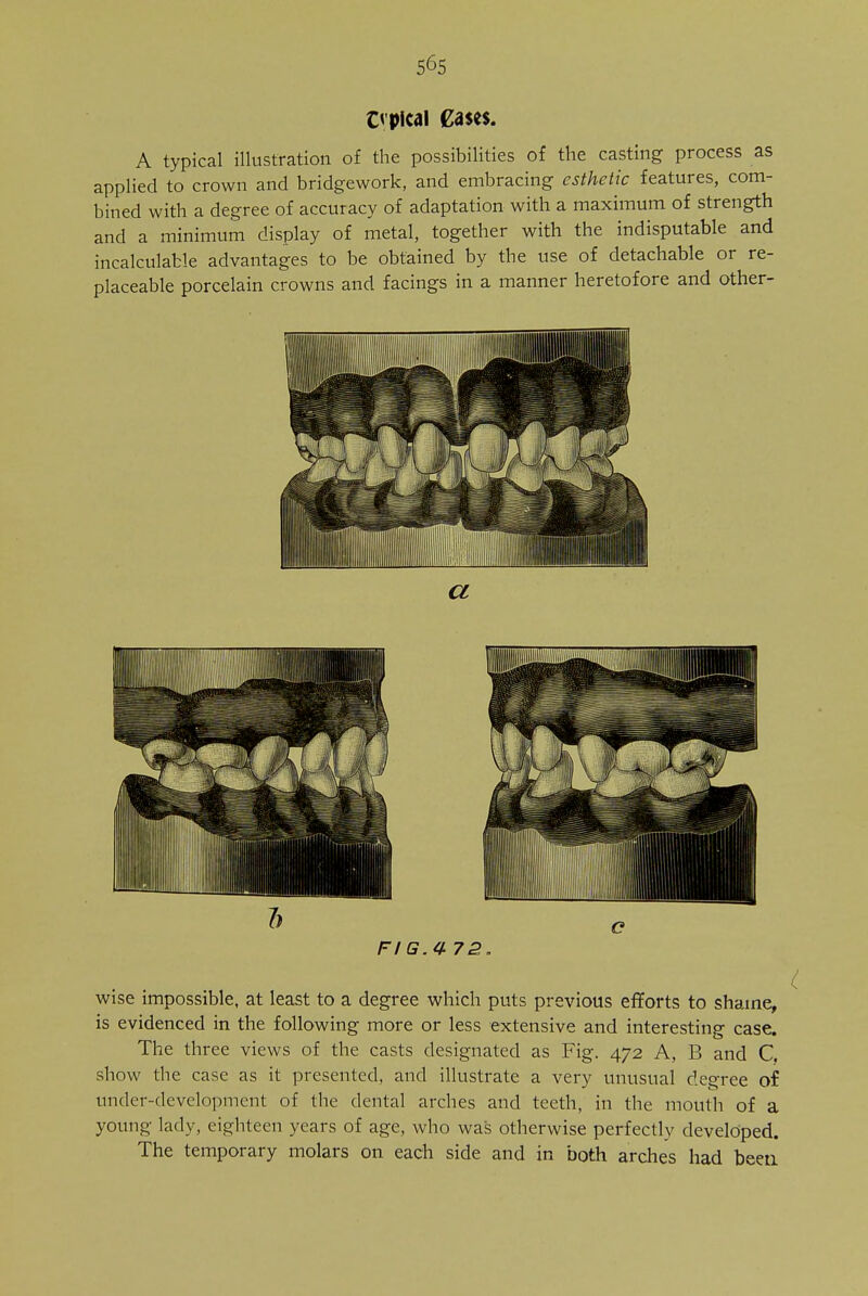 e pical Cases. A typical illustration of the possibilities of the casting process as applied to crown and bridgework, and embracing esthetic features, com- bined with a degree of accuracy of adaptation with a maximum of strength and a minimum display of metal, together with the indisputable and incalculable advantages to be obtained by the use of detachable or re- placeable porcelain crowns and facings in a manner heretofore and other- FIG.4 72. wise impossible, at least to a degree which puts previous efforts to shame, is evidenced in the following more or less extensive and interesting case. The three views of the casts designated as Fig. 472 A, B and C. show the case as it presented, and illustrate a very unusual decree of underdevelopment of the dental arches and teeth, in the mouth of a young lady, eighteen years of age, who was otherwise perfectly developed. The temporary molars on each side and in both arches had been