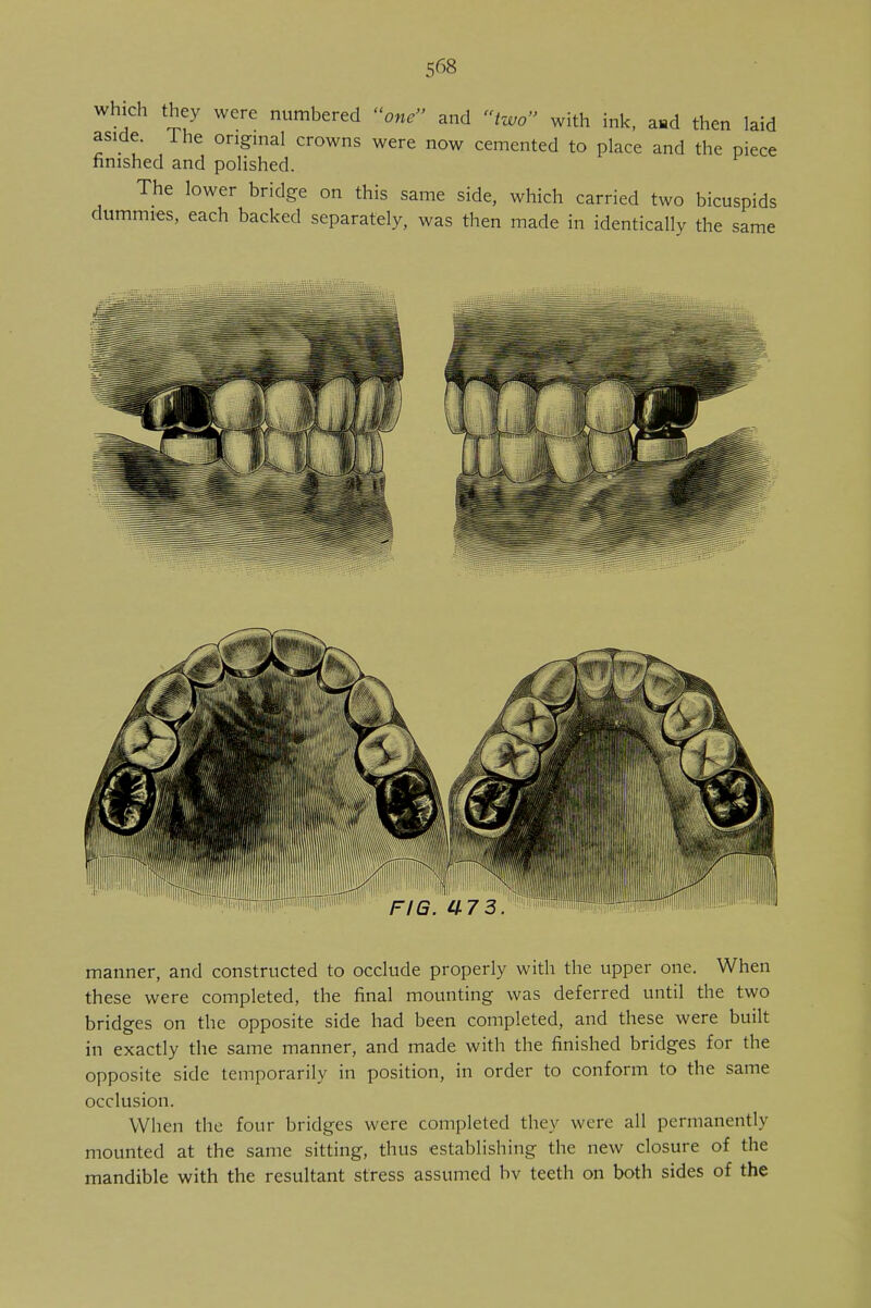 which they were numbered one and two with ink, a*d then laid aside. Ihe original crowns were now cemented to place and the piece finished and polished. The lower bridge on this same side, which carried two bicuspids dummies, each backed separately, was then made in identically the same manner, and constructed to occlude properly with the upper one. When these were completed, the final mounting was deferred until the two bridges on the opposite side had been completed, and these were built in exactly the same manner, and made with the finished bridges for the opposite side temporarily in position, in order to conform to the same occlusion. When the four bridges were completed they were all permanently mounted at the same sitting, thus establishing the new closure of the mandible with the resultant stress assumed bv teeth on both sides of the