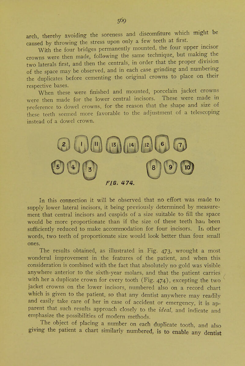 arch, therehy avoiding the soreness and discomfiture which might be caused by throwing the stress upon only a few teeth at first. With the four bridges permanently mounted, the four upper incisor crowns were then made, following the same technique, but making the two laterals first, and then the centrals, in order that the proper division of the space may be observed, and in each case grinding and numbering the duplicates before cementing the original crowns to place on their respective bases. When these were finished and mounted, porcelain jacket crowns were then made for the lower central incisors. These were made in preference to dowel crowns, for the reason that the shape and size of these teeth seemed more favorable to the adjustment of a telescoping instead of a dowel crown. FIG. 474. In this connection it will be observed that no effort was made to supply lower lateral incisors, it being previously determined by measure- ment that central incisors and cuspids of a size suitable to fill the space would be more proportionate than if the size of these teeth haa been sufficiently reduced to make accommodation for four incisors. In other words, two teeth of proportionate size would look better than four small ones. The results obtained, as illustrated in Fig. 473, wrought a most wonderul improvement in the features of the patient, and when this consideration is combined with the fact that absolutely no gold was visible anywhere anterior to the sixth-year molars, and that the patient carries with her a duplicate crown for every tooth (Fig. 474), excepting the two jacket crowns on the lower incisors, numbered also on a record chart which is given to the patient, so that any dentist anywhere may readily and easily take care of her in case of accident or emergency, it is ap- parent that such results approach closely to the ideal, and indicate and emphasize the possibilities of modern methods. The object of placing a number on each duplicate tooth, and also giving the patient a chart similarly numbered, is to enable any dentist