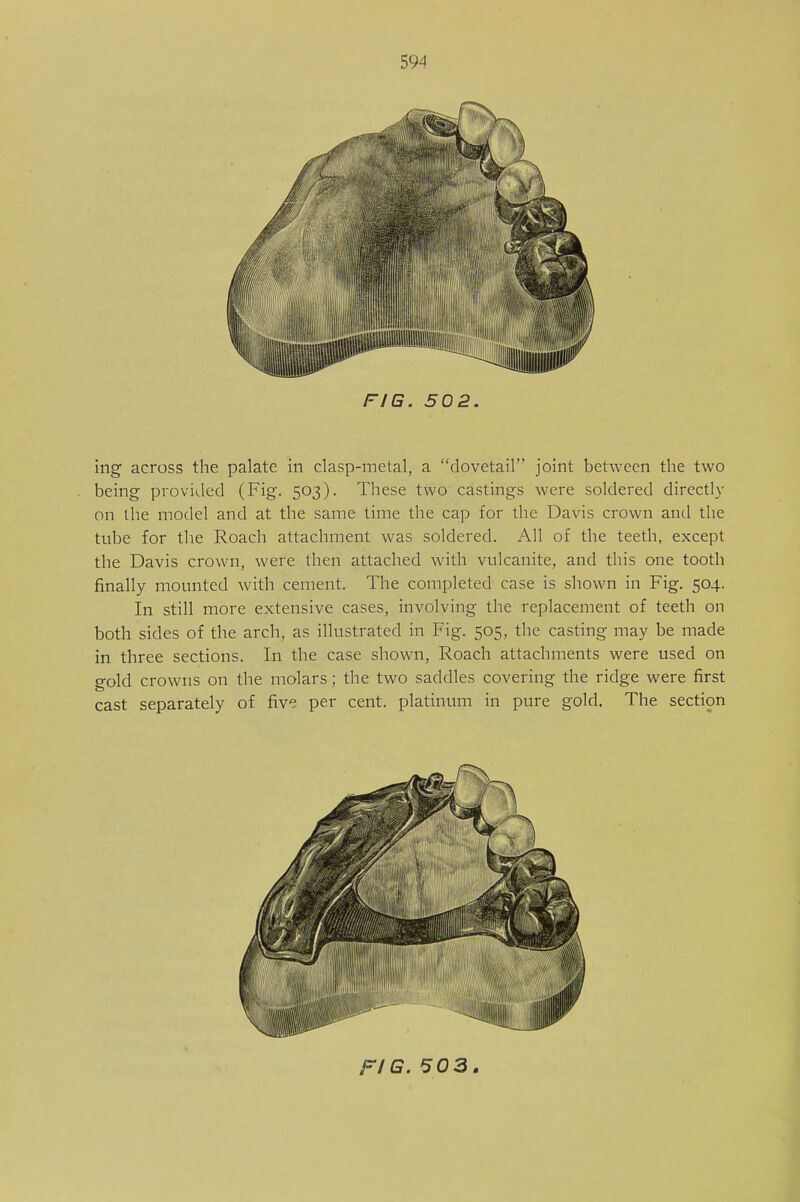 FIG. 502. ing across the palate in clasp-metal, a dovetail joint between the two being provided (Fig. 503). These two castings were soldered directly on the model and at the same time the cap for the Davis crown and the tnbe for the Roach attachment was soldered. All of the teeth, except the Davis crown, were then attached with vulcanite, and this one tooth finally mounted with cement. The completed case is shown in Fig. 504. In still more extensive cases, involving the replacement of teeth on both sides of the arch, as illustrated in Fig. 505, the casting may be made in three sections. In the case shown, Roach attachments were used on gold crowns on the molars; the two saddles covering the ridge were first cast separately of five per cent, platinum in pure gold. The section FIG. 503.