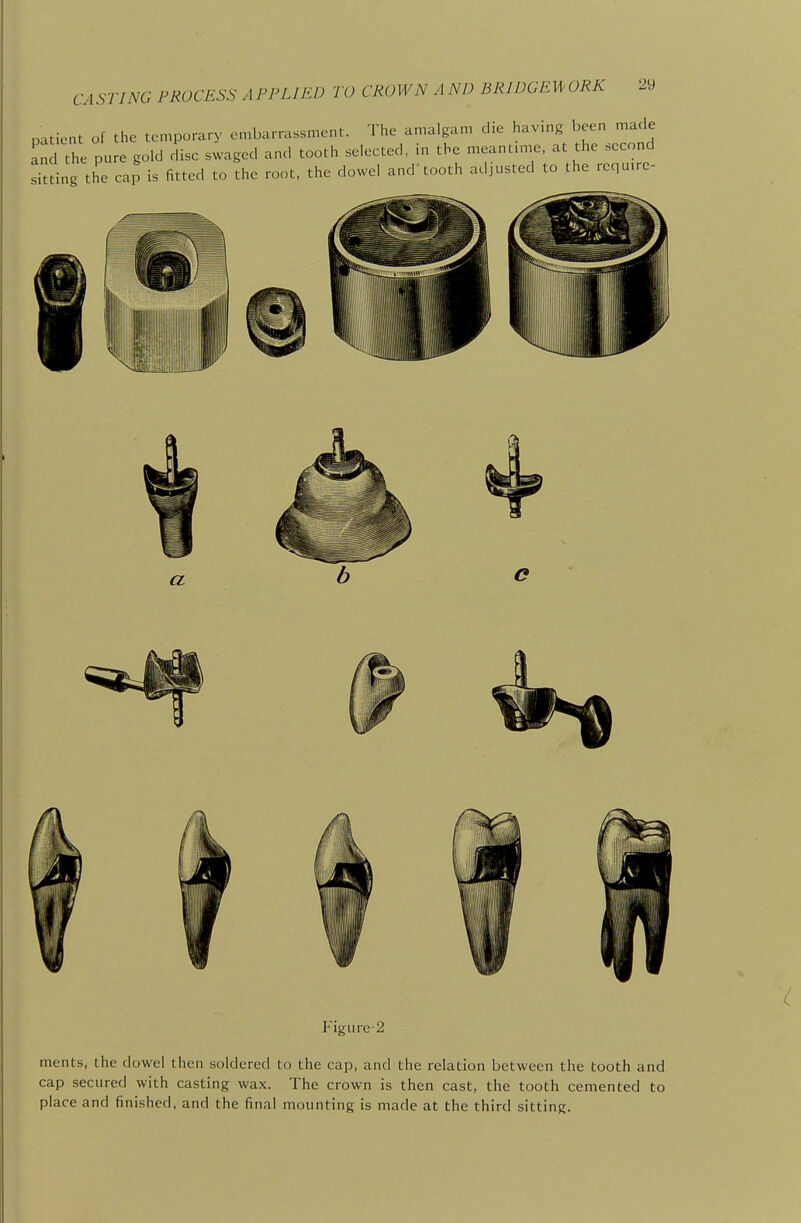 patient of the temporary embarrassment. The amalgam die having been made and the pure gold disc swaged and tooth selected, in the meantime, at the second sitting the cap is fitted to the root, the dowel and'tooth adjusted to the requ.re- Figure-2 ments. the dowel then soldered to the cap, and the relation between the tooth and cap secured with casting wax. The crown is then cast, the tooth cemented to place and finished, and the final mounting is made at the third sitting.