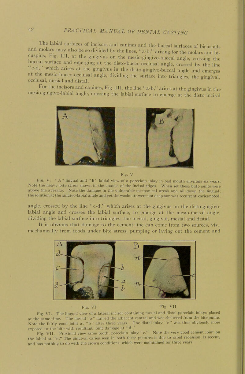 The labial surfaces of incisors and canines and the buccal surfaces of bicuspids and molars may also be so divided by the lines, a-b, arising for the molars and bi- cuspids, hig. Ill, at the gingivus on the mcsio-gingivo-buccal angle, crossing the buccal surface and emerging at the disto-bucco-occlusal angle, crossed by the line c-cl, which arises at the gingivus in the disto-gingivo-buccal angle and emerges at the mesio-bucco-occlusal angle, dividing the surface into triangles, the gingival occlusal, mesial and distal. For the incisors and canines. Fig. Ill, the line a-b, arises at the gingivus in the mesio-gingivo-labial angle, crossing the labial surface to emerge at the disto incisal iMg. V Fin. V. A lingual and B labial view of a porcelain inlay in bad mouth environs six years. Note the heavy bite stress shown in the enamel of the incisal edges. When set these butt-joints were above the average. Note the damage in the vulnerable mechanical areas and all down the lingual; the solution at the gingivo-labial angle and yet the washouts were not deep nor was recurrent caries noted. angle, crossed by the line c-d, which arises at the gingivus on the disto-gingivo- labial angle and crosses the labial surface, to emerge at the mesio-incisal angle, dividing the labial surface into triangles, the incisal, gingival, mesial and distal. It is obvious that damage to the cement line can come from two sources, viz., mechanically from foods under bite stress, pumping or laving out the cement and Fig. VI Fig VII Fig. VI. The lingual view of a lateral incisor containing mesial and distal porcelain inlays placed at the same time. The mesial a lapr-ed the adjacent central and was sheltered from the bite pump. Note the fairly good joint at 1) after three years. The distal inlay c was thus oliviously more expo.sed to the bite with resultant joint damage at d. Fig. VII. Proximal view same tooth, porcelain inlay c. Note the very good cement joint on the labial at n. The gingival caries .seen in both these pictures is due to rapid recession, is recent, and has nothing to do with the crown conditions, which were maintained for three years.