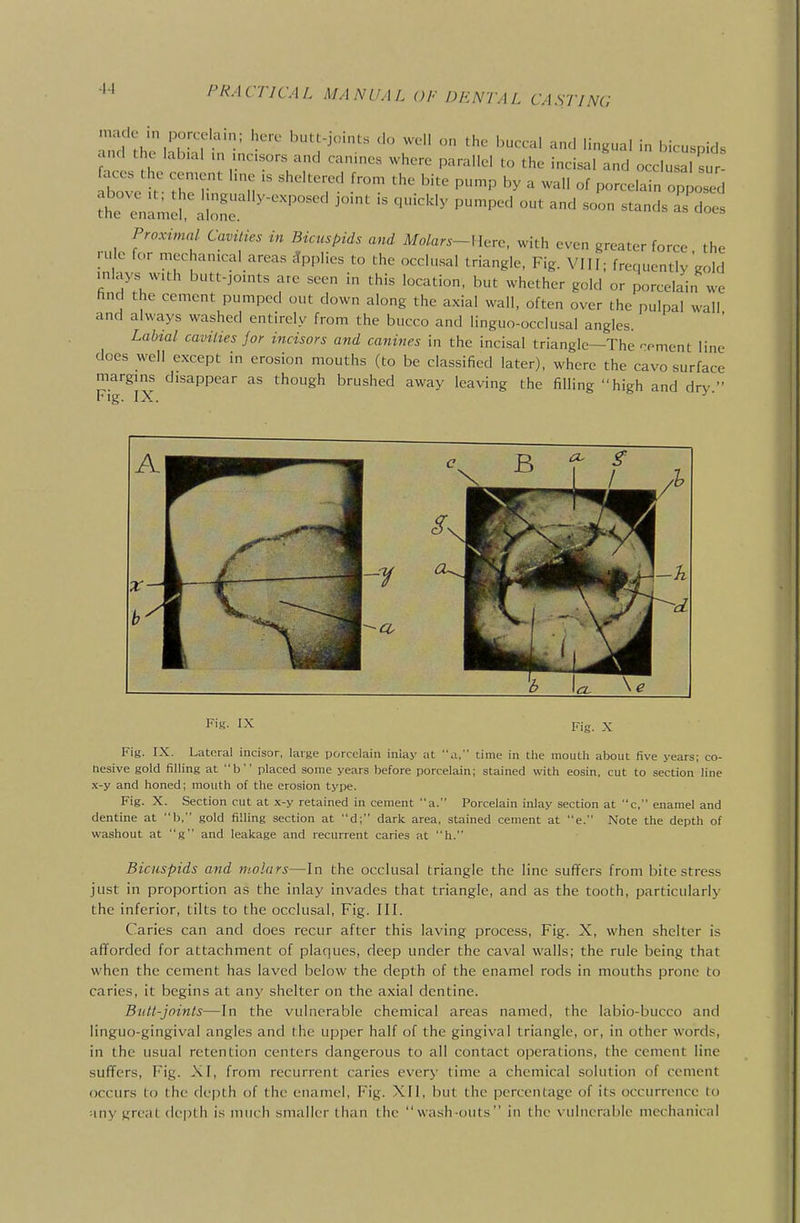 made in porcelain; here butt-joint. <!o well on the buccal and lingual in bicuspids and the labuU .n mc.sors and canines where parallel to the incisal and occlusal s t Ibove t' I '^'^^ '^^'^ ^ °f porcelain oppoTd Prar/mn/ Ca«/,>.v Mo/a..-I Ierc, with even greater force the ru 0 for mechanical areas Applies to the occlusal triangle, Fig. VIII; frequently gold inlays with butt-joints are seen in this location, but whether gold or porcelain we hnd the cement pumped out down along the axial wall, often over the pulpal wall and always washed entirely from the bucco and linguo-occlusal angles. Labtal cavities for incisors and canines in the incisal triangle—The -oment line does well except in erosion mouths (to be classified later), where the cavo surface margins disappear as though brushed away leaving the filling high and dry  Fig. IX. Fig. IX Fig. X Fig. IX. Lateral incisor, large porcelain iniay at a, time in the mouth about five years; co- hesive gold filling at b placed some years before porcelain; stained with eosin, cut to section line x-y and honed; mouth of the erosion type. Fig. X. Section cut at x-y retained in ceinent a. Porcelain inlay section at c, enamel and dentine at b, gold filling section at d; dark area, stained cement at e. Note the depth of washout at g and leakage and recurrent caries at h. Bicuspids and molars—In the occlusal triangle the line suffers from bite stress just in proportion as the inlay invades that triangle, and as the tooth, particularly the inferior, tilts to the occlusal, Fig. III. Caries can and does recur after this laving process, Fig. X, when shelter is afforded for attachment of plaques, deep under the caval walls; the rule being that when the cement has laved below the depth of the enamel rods in mouths prone to caries, it begins at any shelter on the axial dentine. Butt-joints—In the vulnerable chemical areas named, the labio-bucco and linguo-gingival angles and the upper half of the gingival triangle, or, in other words, in the usual retention centers dangerous to all contact operations, the cement line suffers. Fig. XI, from recurrent caries every time a chemical solution of cement occurs to the depth of the enamel, Fig. XII, but the percentage of its occurrence to any grcal depth is much smaller than the wash-outs in the vulnerable mechanical